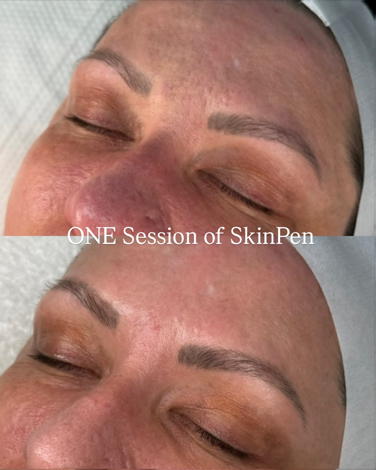 If your microneedling isn’t smoothing your scarring like this after ONE session… something isn’t right 🤯✨
Look at the difference. The texture is more refined, the scarring has softened substantially, and the skin already looks smoother and healthier - and this is just the beginning for this client 😍
This is what happens when microneedling is done properly with SkinPen. Not a temporary glow, but real collagen stimulation so the skin rebuilds itself from within 🧬
Yes, it’s more of an investment than standard microneedling - but this is exactly why ⬆️
You’re not paying for more sessions, you’re paying for better results 🙌🏼
Most people spend years trying to fix scarring with cheaper treatments that don’t fully work:
£75 x 12 sessions = £900
vs
£180 x 3 sessions = £540
So which actually costs more? 👀
Better treatment, better outcome, fewer sessions 👏🏼
If you’re ready to actually rebuild your skin and get rid of that acne scarring once and for all - instead of chasing results, just DM me “SKINPEN” 🫶🏼✨