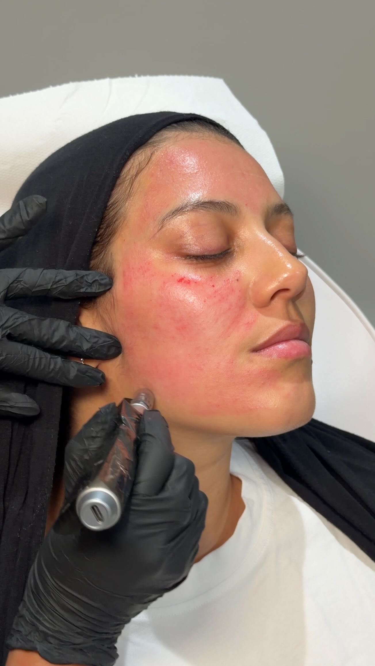 Another day, another microneedling session ✨
One of our most popular treatments for acne scars, enlarged pores, uneven skin texture & overall smoother, healthier-looking skin. Results that keep getting better with every session 🤍