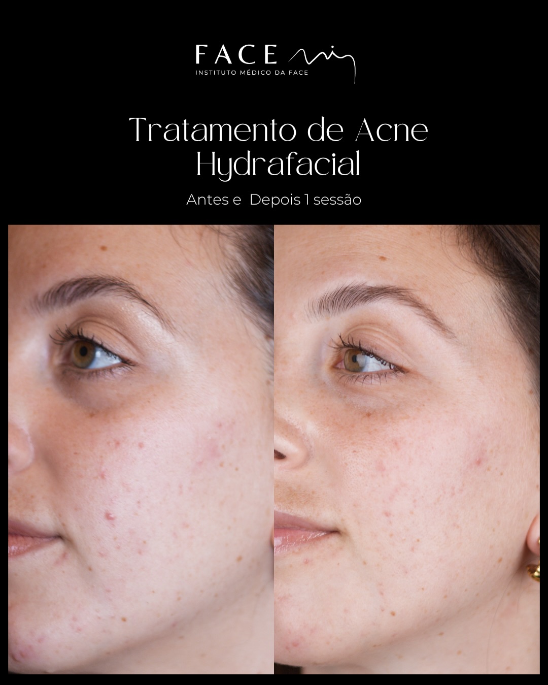 Acne não é “só uma fase”.
É uma condição inflamatória que afeta a pele, mas também a forma como muitas pessoas se vêem ao espelho.
Este antes e depois não mostra apenas menos acne.
Mostra uma pele mais equilibrada, saudável.
No caso da Inês, o tratamento ainda está a decorrer, porque depois de melhorar as borbulhas com Hydrafacial, Skincare e tratamento médico agora é vez de melhorar as Manchas que ficaram.
O processo continua…
Em breve, a Inês vai iniciar o tratamento com BBL, uma das tecnologias mais avançadas para melhorar marcas, vermelhidão e qualidade global da pele.
Porque tratar o acne não é “secar borbulhas”.
É cuidar da pele de forma inteligente, respeitando cada fase do processo.
Os casos clínicos apresentados refletem o antes e depois de pacientes específicos. Cada pessoa é única e o resultado pode variar de paciente para paciente.
Todos os pacientes, antes de cada procedimento, passam por um processo de consulta médica de diagnóstico onde são avaliadas indicações, expectativas e motivações.
Registo ERS: 21236
Registo estabelecimento: E159774
Licença funcionamento: 21236/2022
#acne #manchasacne #laseracne #bbl #facemiporto