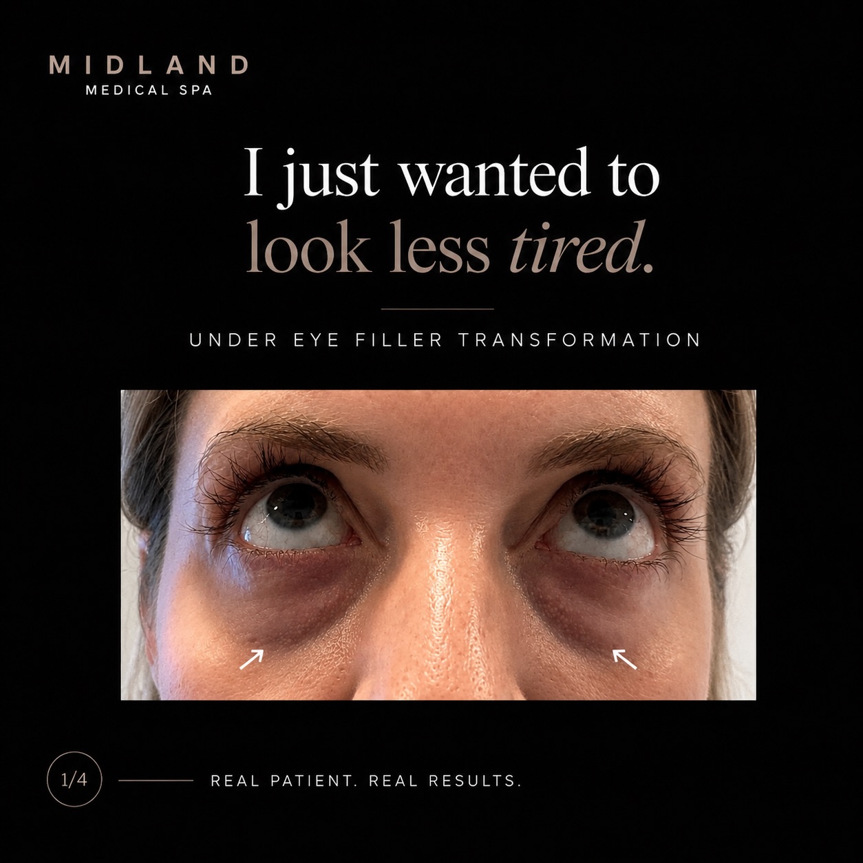 “I just wanted to look less tired.” ✨
A subtle under-eye refresh using Teoxane Redensity 2 — a dermal filler specifically designed for the delicate tear trough area. Formulated with hyaluronic acid, amino acids, antioxidants, minerals, and vitamins to support hydration and soft, natural-looking correction.
This treatment was performed using a cannula technique to help minimise bruising and downtime while improving under-eye shadowing and hollowing.
Results are immediate, with outcomes that can last 9 months+ depending on the individual.
Performed by medical practitioner at Midland Clinic Coventry.
#UndereyeFiller #TeoxaneRedensity2 #TearTroughFiller #NaturalAesthetics #MedicalSpa