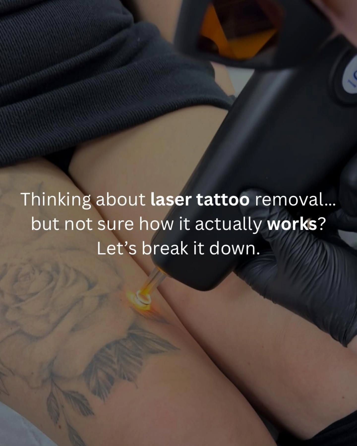 🔥🤍 LASER TATTOO REMOVAL 🤍🔥
Thinking about tattoo removal but not sure how it actually works?
Laser tattoo removal works by sending short pulses of energy into the skin to break the tattoo ink into tiny particles. Your body then naturally clears the shattered ink away over time. 🤍
That’s why multiple sessions are usually needed — tattoos have layers of ink, and each session helps fade the tattoo more and more.
Black and darker inks often respond the quickest, while some colours can take longer depending on the pigment used. ✨
Whether you want complete removal or fading for a cover up, every treatment plan is tailored to you.
Patience. Consistency. Results. 🤍
#tattooremoval #lasertattooremoval #tattooremovalwarrington #lasertattooremovalwarington #aestheticswarrington
