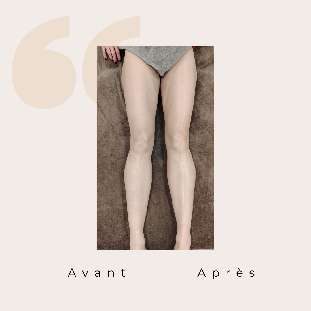 ✨ Avant / Après – Drainage lymphatique Renata França ✨
Dès la première séance, le corps réagit.
Des jambes visiblement plus légères, un galbe redessiné et une sensation immédiate de bien-être 🌿
Le drainage lymphatique Renata França agit en profondeur pour :
✨ stimuler la circulation lymphatique
✨ réduire la rétention d’eau
✨ affiner et détoxifier les jambes
✨ apporter une sensation de légèreté durable
Résultat visible, ressenti immédiat 🤍
Chaque corps est unique, les résultats peuvent varier, mais la légèreté, elle, est toujours au rendez-vous ✨
#drainagelymphatique #renatafranca #avantapres #jambeslegeres #retentiondeau #bienetre #soincorps #detox #momentpoursoi