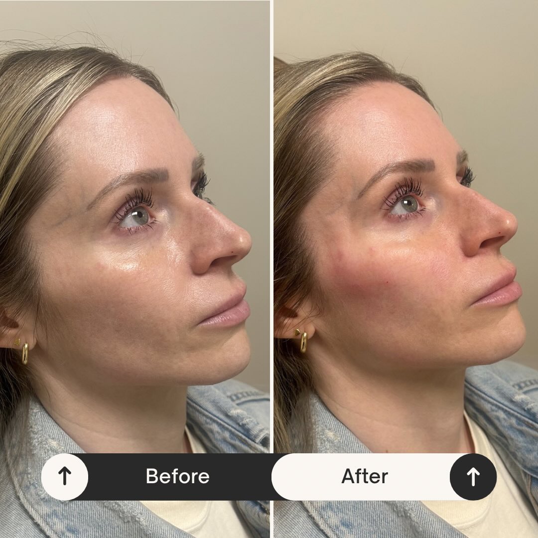 We didnāt add volume to the nasolabial foldā¦
we fixed what was causing it.
3 syringes placed in the temples + cheeks
to restore support and create a subtle lift through the midface.
When structure is corrected, everything below it improves.
This is facial balancingānot chasing lines.
Temporal filler is one of the most overlooked areas, but it makes a bigger difference than most people realize.
Slight temporal bumpiness right after is normal and will settle as the product integrates.
Natural. Refined. Done with intention