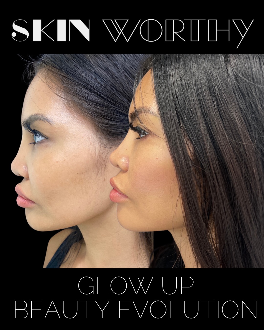 One of the most important parts of achieving natural-looking aesthetic results is having a thoughtful plan and sticking with a provider you truly trust.
Sometimes, though, you don’t know what that looks like until you’ve experienced results that don’t feel like you.
This beauty has been a long-time patient of Nurse Barb, but early in her aesthetic journey, she explored other providers. When she wasn’t achieving the natural-looking outcome she wanted, she returned to Nurse Barb and committed to a Beauty Evolution plan designed around skin health, quality, balance, and honouring her natural anatomy.
Her plan included a combination of treatments such as dermal filler, filler dissolving, nonsurgical nose job, anti-wrinkle injections, and Skinergy treatments all working together over time toward a softer, more refined, natural result.
We think she looks incredible, but most importantly, so does she.
To learn more or start your own Beauty Evolution, click the link in our bio or call/text us at 647-350-7546.