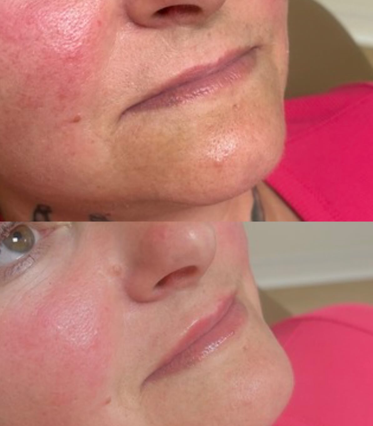Natural lip filler journey for very thin lips 🤍
With lips this thin, the goal is never to overfill or force volume too quickly. That’s how filler migration and unnatural results happen.
We started with a lip flip first to create a little more visible lip space before even touching filler. Today, we added a subtle half syringe for a soft, natural start ✨
She’ll likely need another half syringe over time to reach her goal — but beautiful lips are built slowly, strategically, and safely.
At Villa, we are BIG believers in the “slow and natural” approach. Especially with thin lips. Small adjustments over time will always look better than trying to do too much at once 💋