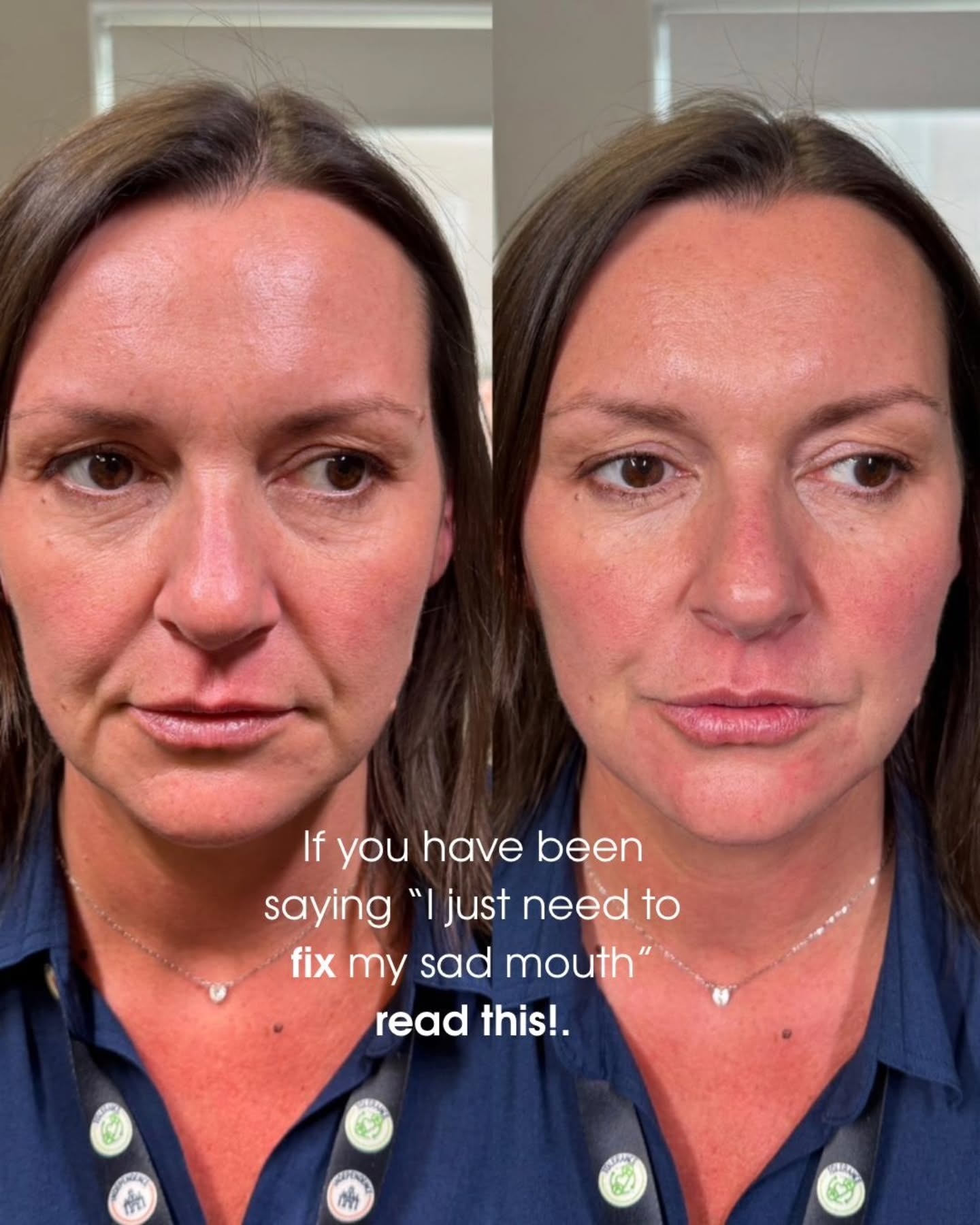 🤍✨ BEFORE YOU TREAT THE “SAD MOUTH” — READ THIS ✨🤍
Sometimes it’s not just the lines around the mouth causing that tired or downturned appearance… it’s actually volume loss in the surrounding support areas.
By carefully restoring structure and support with strategically placed dermal filler, we can soften marionette lines while keeping everything looking natural, fresh, and balanced. 🤍
The goal is never to make you look different — just a more refreshed version of you.
Results tailored to facial anatomy. ✨
#dermalfiller #marionettelines #aestheticswarrington #naturalresults #facialbalancing
