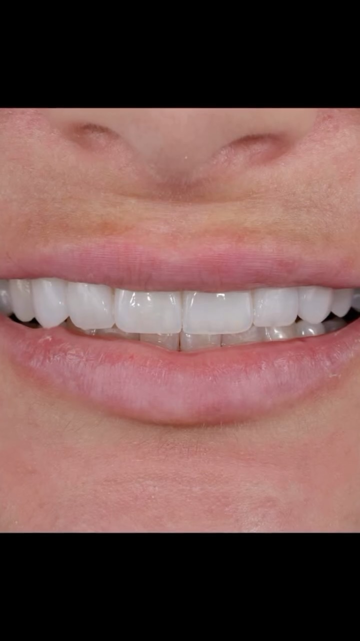 Natural white smile💎
With carefully designed porcelain veneers,
we enhance natural features not replace them.
Subtle. Balanced. Personal.
DISCLAIMER
All information provided by Dr Matthew El Azzi - DEN0001996783, Registered Dentist, is for general and educational purposes only. It does not constitute medical advice and should not be relied upon as a substitute for professional consultation.
Images and videos are of real patients who have given consent. No filters, AI enhancements, or unrealistic lighting are used. These materials are intended to demonstrate examples of treatment but do not guarantee results. Individual results, risks, potential complications, and recovery times vary between patients.
Patient stories are individual experiences and should not be interpreted as indicative of expected outcomes for all patients. Your experience may differ.
Before commencing any treatment, you should seek independent advice from a qualified, AHPRA-registered health practitioner and consider obtaining a second opinion.
For details about each specific treatment, head to:
https://www.iconicsmiles.com.au
Dr Matthew El Azzi - DEN0001996783
Registered Dentist, General Registration