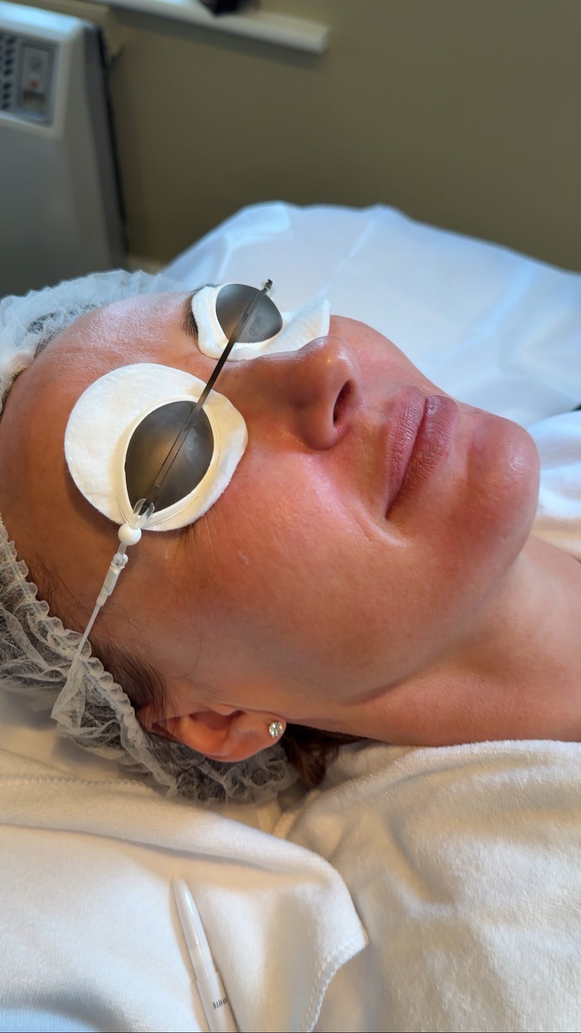 ✨ // FRAX Laser Resurfacing Offer // ✨
Ready for smoother, fresher, glowing skin?
Our advanced FRAX laser resurfacing helps improve:
• Skin texture & pores
• Fine lines and early ageing
• Acne scarring
• Pigmentation & sun damage
• Overall skin rejuvenation
📍 Special Offer Dates Only:
• 18th May
• 8th June
💫 Full Face FRAX — ONLY €250 💫
Limited availability for these clinic days.
Booking essential via Priory Medical