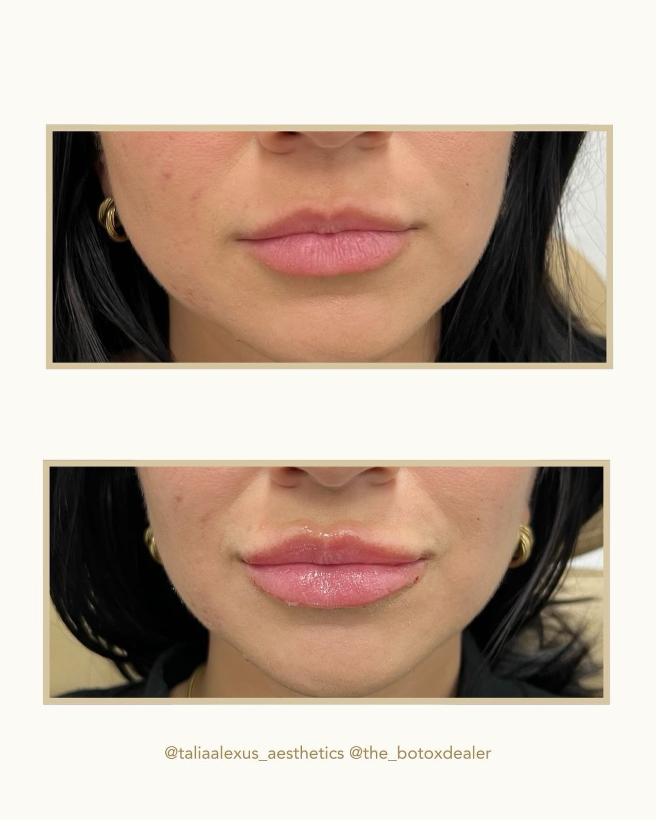 When you just needed a little something subtle… don’t worry—our lips are sealed, and yours will be filled😘
⠀⠀⠀⠀⠀⠀⠀⠀⠀
👩🏻⚕️Injector: @taliaalexus_aesthetics
💉Procedure: Lip filler using Revanesse
⏱Time Spent: 30-45 minutes
❤️🩹Pain: Varies by client-topical anesthetic used
📅Longevity: Typically 6-12 months
🤩Results: Immediate—swelling and bruising is common for the first 5-7 days
🩹Aftercare: Avoid alcohol, NSAIDs, and exercise for 24-48 hours after procedure. Instructions provided at the time of your appointment