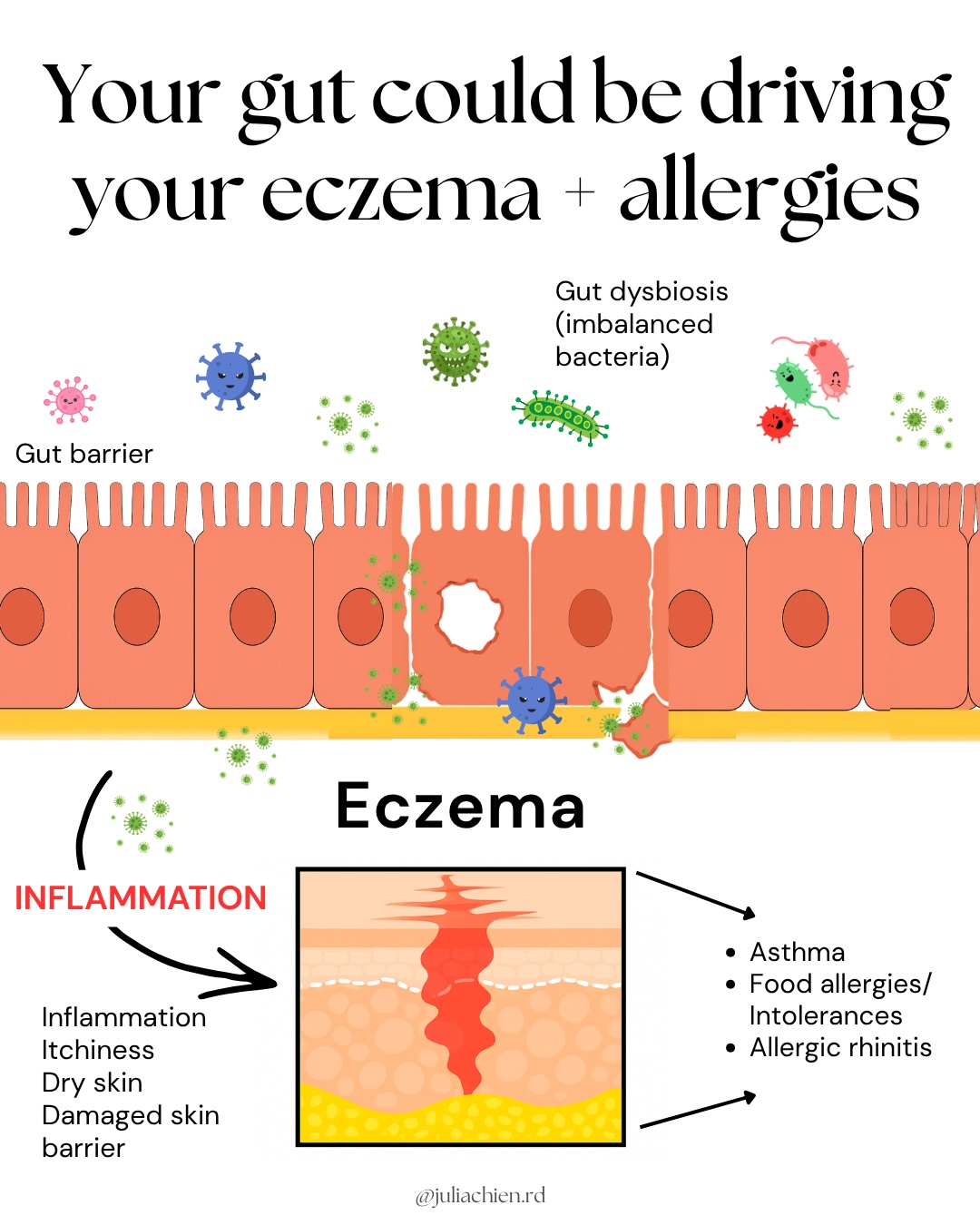 Your skin is a reflection of what is happening inside the gut.
And while gut dysbiosis (imbalance in bacteria) isn’t the ONLY root cause of eczema, it is a common one we see in practice
Gut dysbiosis can develop from:
- Previous antibiotic history
- Chronic infections (Candida, H pylori)
- Highly processed, low fiber diet
- Chronic stress + Nervous system dysregulation
- Medications (antibiotics, birth control, PPis)
And if you’re someone dealing with eczema + allergies (the “Atopic March”)
there’s often a deeper connection between your gut, immune system, and skin.
This is why you can be doing everything “right” like eating clean, taking supplements, but still flare.
👉🏼 Because eczema isn’t just about one diet, one trigger, one supplement, or one root cause.
Addressing eczema means looking at the bigger picture.
If you feel like you’ve tried everything and still feel stuck…
Comment GUT and I’ll send you a list of foods for your gut + skin and how we can support you deeper.
📌 Save this for later & share with someone dealing with eczema or allergies!
#eczemahealing #gutskinconnection #eczemahelp #atopicdermatitis #allergies
