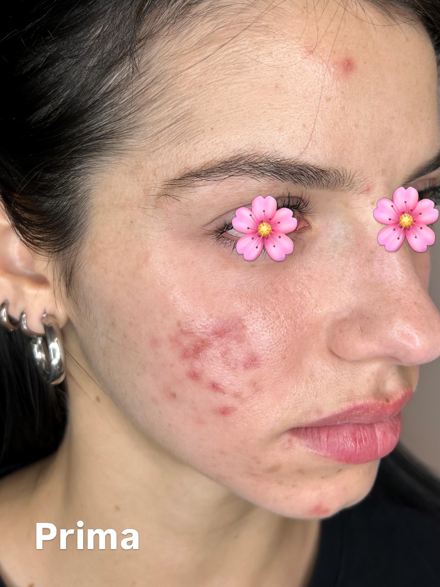 L’acne non è solo pelle.
È evitare gli specchi, coprirsi, sentirsi a disagio anche nei giorni belli.
Ma la pelle può guarire. E con lei anche il modo in cui ti guardi.
Rinascere dall’acne significa smettere di combattere contro te stessa e iniziare finalmente a prenderti cura di te.
Ogni cicatrice racconta una battaglia, ma non definirà mai la tua bellezza. ✨
#acne #acnecare #acnetreatment #acnepositivity