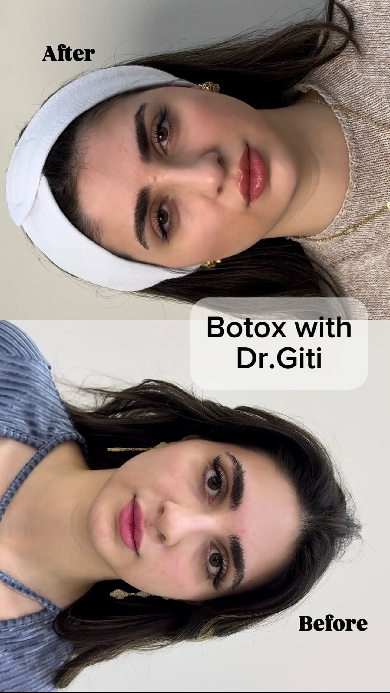 Simply Get your Botox Done ✅
Using Trusted Brands 👍🏼
Good Injection Technique🤌🏼
And Balanced Frequency and dosage ✌🏼
And you will benefit from Botox in short and Long term 😎
.
.
.
#botox #botoxdubai