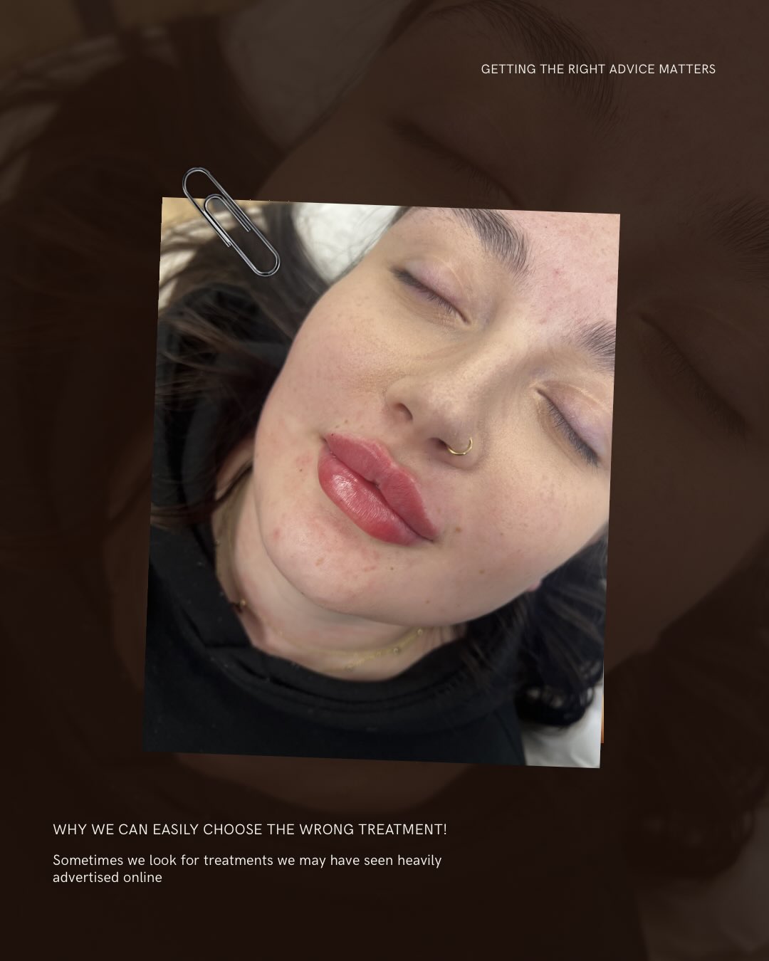 Most people don’t get bad results because treatments “don’t work”…
They get bad results because they’re having the WRONG treatment for their concern.
Loose skin and volume loss are not the same thing.Texture and laxity are not the same thing.And more filler is not always the answer.
This is why consultations matter so much.
I look at: skin quality, facial structure, collagen loss, movement, for example whether you actually need volume OR tightening
Because natural results come from choosing the RIGHT treatment — not just following trends.
And honestly? Sometimes the best treatment is the one you didn’t expect