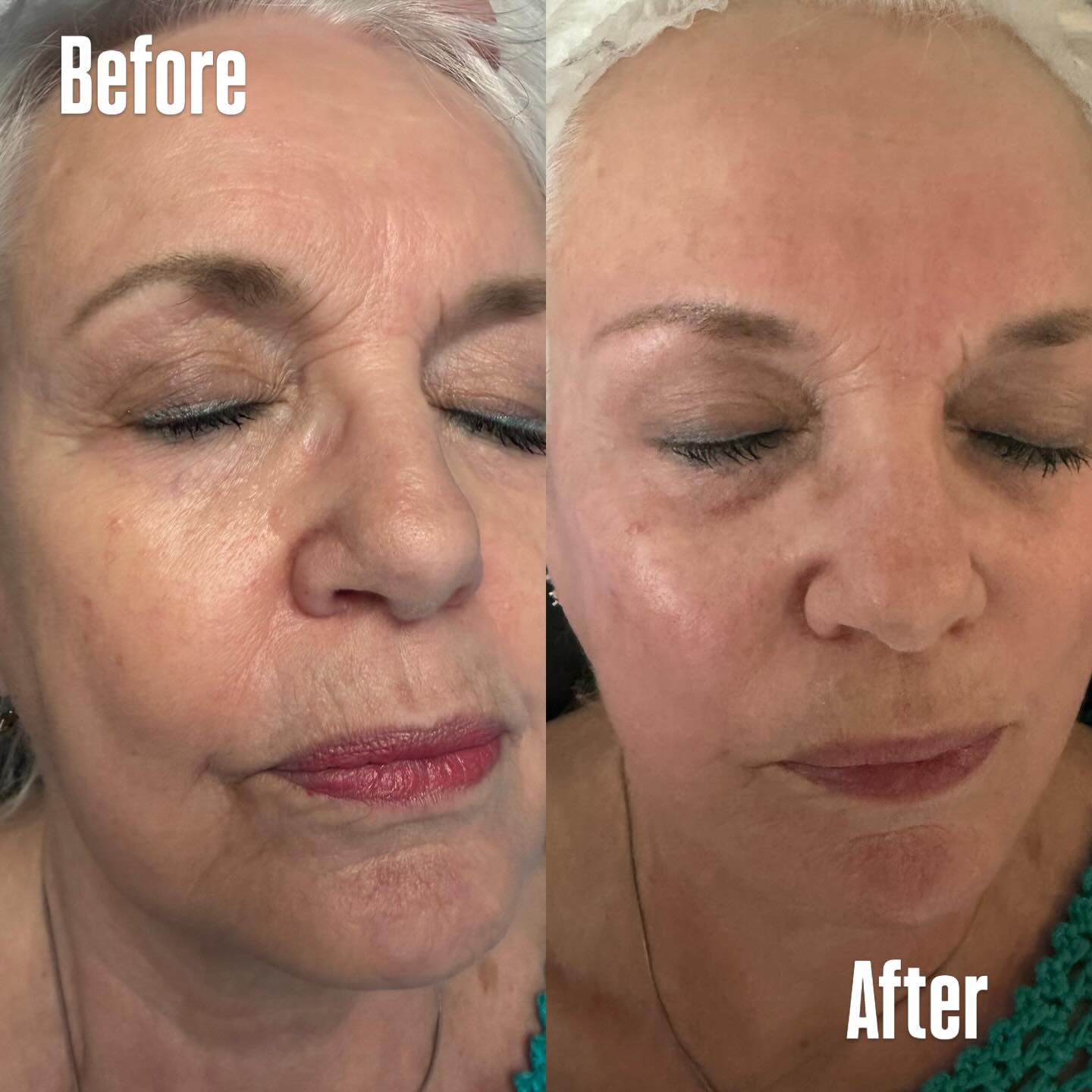 Natura Peel Facial - with Jen - May Promo $250 Book soon