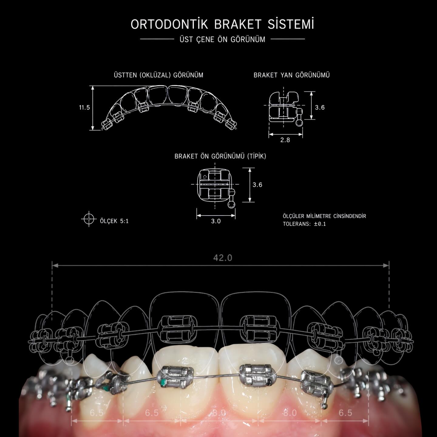 🔹 Ortodontik braket sistemi sadece dişlerin üzerine yapıştırılan küçük aparatlar değildir; her bir braket, dişlerin kontrollü ve doğru hareket etmesi için milimetrik ölçülerle planlanır.
Bu görselde üst çene braket yerleşimi, tel sistemi ve teknik ölçülendirmeler şematik olarak gösterilmektedir. Tedavi sürecindeki her detay; estetik, fonksiyon ve sağlıklı kapanış için özel olarak hesaplanır. ✨Bu teknik şema, üst çene braket sisteminin ölçülendirilmiş yerleşimini göstermektedir. Sağlıklı ve estetik bir gülüş için her detay önemlidir. ✨
#ortodonti #i̇zmir #torbalı #teltedavisi #dental