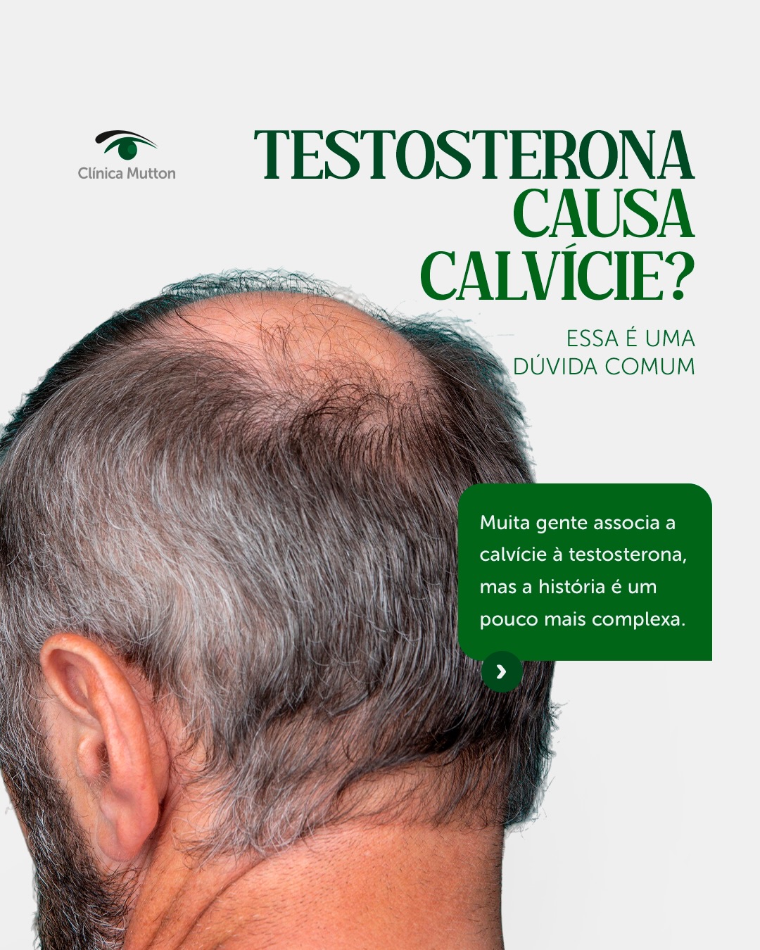 Muita gente acredita que ter muita testosterona causa calvície.
Na verdade, o que influencia é a sensibilidade do seu couro cabeludo à DHT, um derivado da testosterona.
Essa sensibilidade é genética e faz parte da chamada alopecia androgenética, a forma mais comum de calvície masculina.
Agende sua consulta e cuide da saúde do seu cabelo com quem entende.