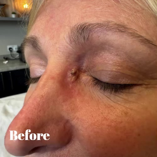 We continue to see some amazing results for skin lesion removal here in clinic ⭐
Cryotherapy with CryoPen offers a highly effective solution for removing larger skin tags and lesions with millimetre precision and no collateral damage to healthy tissue. This lesion was treated once and the photo's were taken 4 weeks apart, showing brilliant results.
We also have Advanced Electrolysis treatments available for smaller tags, fine red veins and blood spots. To find out more, or to book an appointment, visit our website (link in our bio) or call us on 01256 770022 and we'll be happy to help 😊 #physicalbalance #thestudioatphysicalbalance #basingstokeclinic #skintagremovalbasingstoke #skintagremoval #advancedelectrolysisbasingstoke #advancedelectrolysis #cryopenbasingstoke #cryopen #cryotherapybasingstoke #cryotherapy #benignlesionremovalbasingstoke