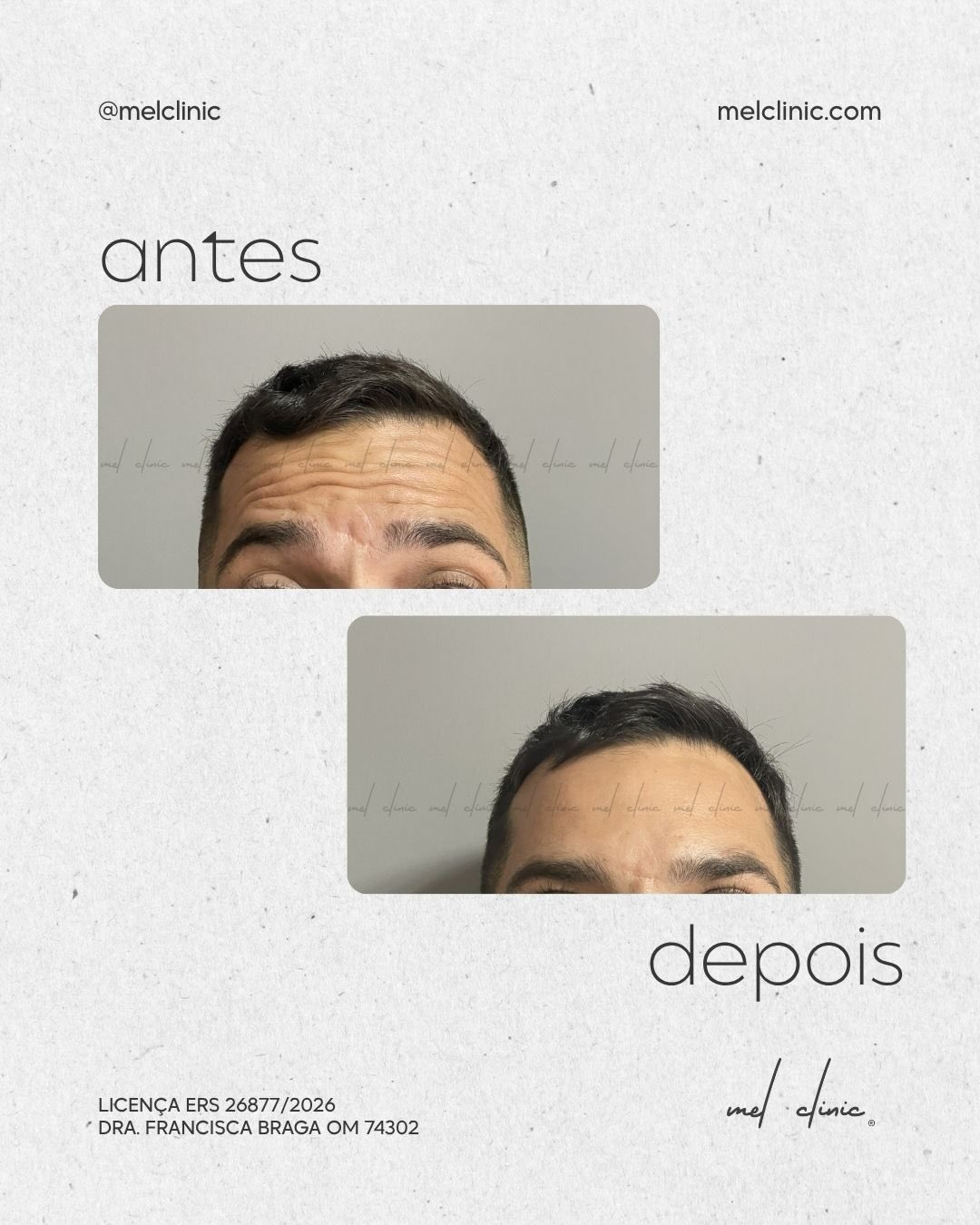 A toxina botulínica (conhecida como “botox”) é um dos tratamentos mais procurados na medicina estética — e por boas razões.
Relaxa temporariamente os músculos responsáveis pelas linhas de expressão, suavizando rugas e contribuindo para a melhoria da qualidade da pele.
Se gostavas de dar mais luz ao teu rosto e diminuir a aparência das rugas, mantendo a naturalidade, marca a tua avaliação! 💉✨🤍
#ToxinaBotulinica #MedicinaEstetica #Botox #AntesEDepois