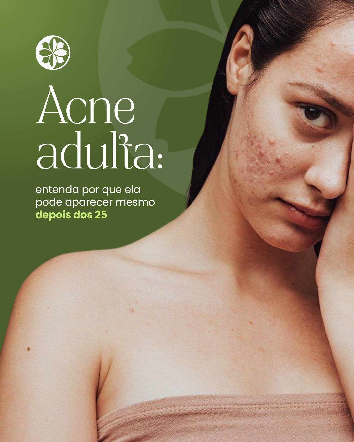 A acne não é exclusiva da adolescência.
Depois dos 25, ela costuma estar ligada a fatores como alterações hormonais, estresse, alimentação e até ao uso de dermoativos que não são adequados para o seu tipo de pele.
Diferente da acne juvenil, a acne adulta exige um cuidado mais estratégico, com ativos que tratem sem agredir e que ajudem a equilibrar a pele ao longo do tempo.
Nesse processo, dermoativos como o Limpeza Própolis, Mousse Chá-verde e/ou a Biosoft Mask podem ser aliados, ajudando na uniformização da pele e na melhora do aspecto das marcas, enquanto uma rotina bem estruturada contribui para o controle e a prevenção.
O mais importante é entender que a pele mudou, e o cuidado também precisa evoluir.
💬 Comenta ACNE que nossa equipe te orienta com os dermoativos ideais para você. 💚