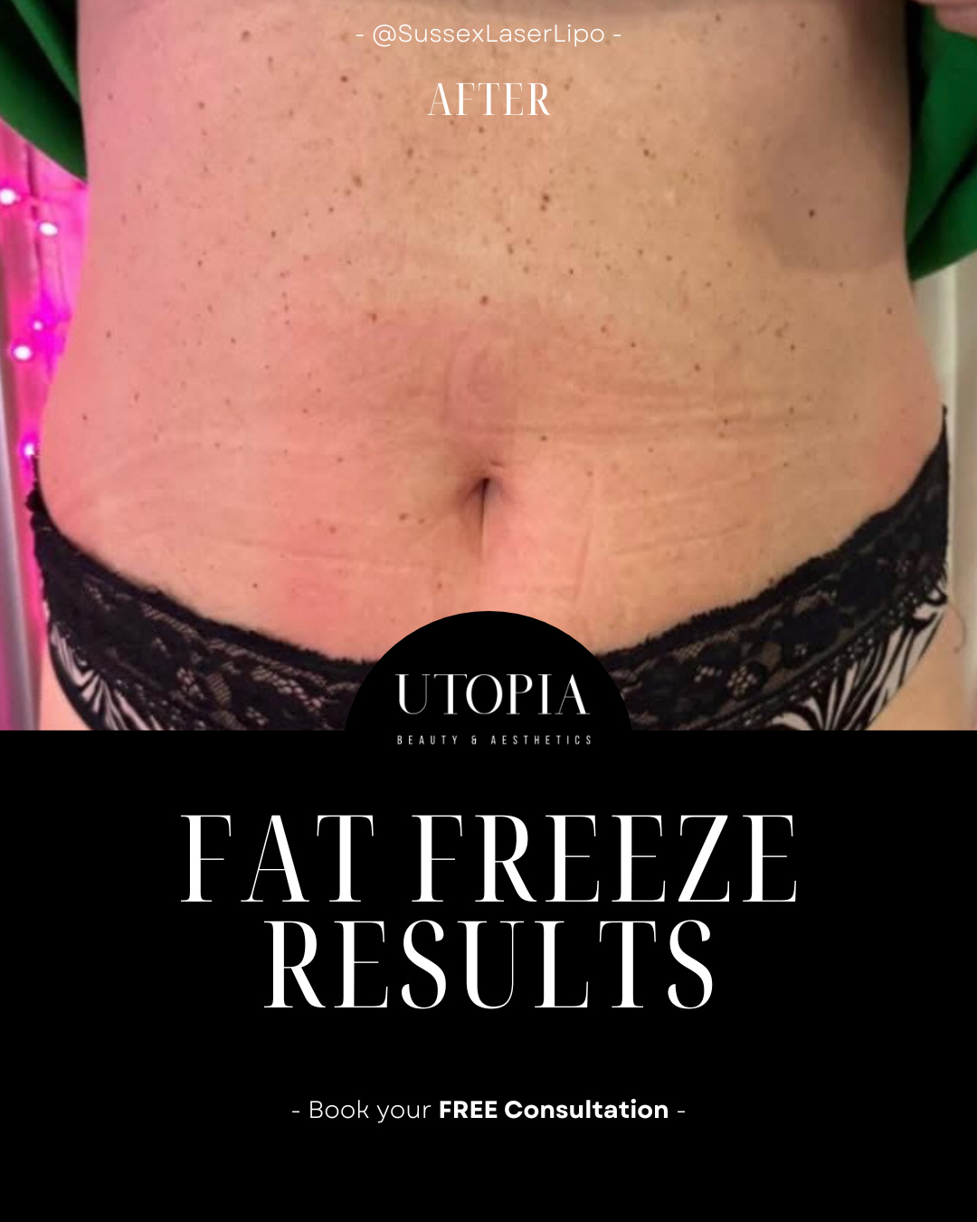 โ๏ธ Target stubborn areas with non-invasive fat freezing, designed to reduce fat and contour the body over time โ with no needles and no downtime.
โ๏ธ Non-surgical
โ๏ธ Targets stubborn fat
โ๏ธ Results develop in the weeks that follow
๐ Utopia Beauty & Aesthetics, Menai Bridge
๐ DM us to book your consultation
๐ธ Images by Sussex Laser Lipo