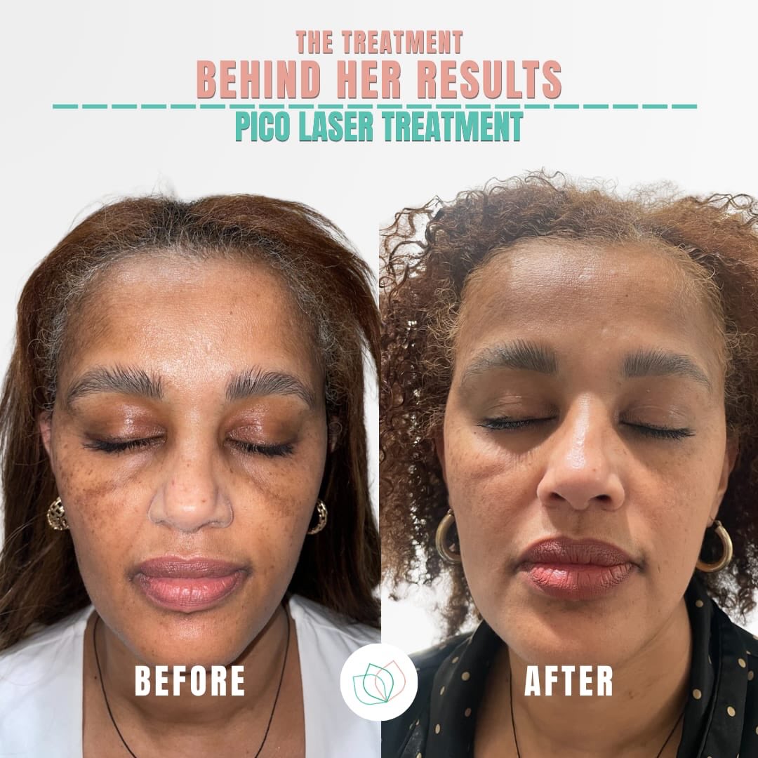 The power of Pico. ✨
Look at the incredible shift in skin tone and clarity.
Ready for your own reveal?
🔗Tap the link in our bio to book your Pico Laser consultation!
💸Flash Sale Alert: all lasers $350 (original $500) until May 13, 2026
#atlantaskincare #picolaseratl #skintransformation #atlskin #atlantamedspa