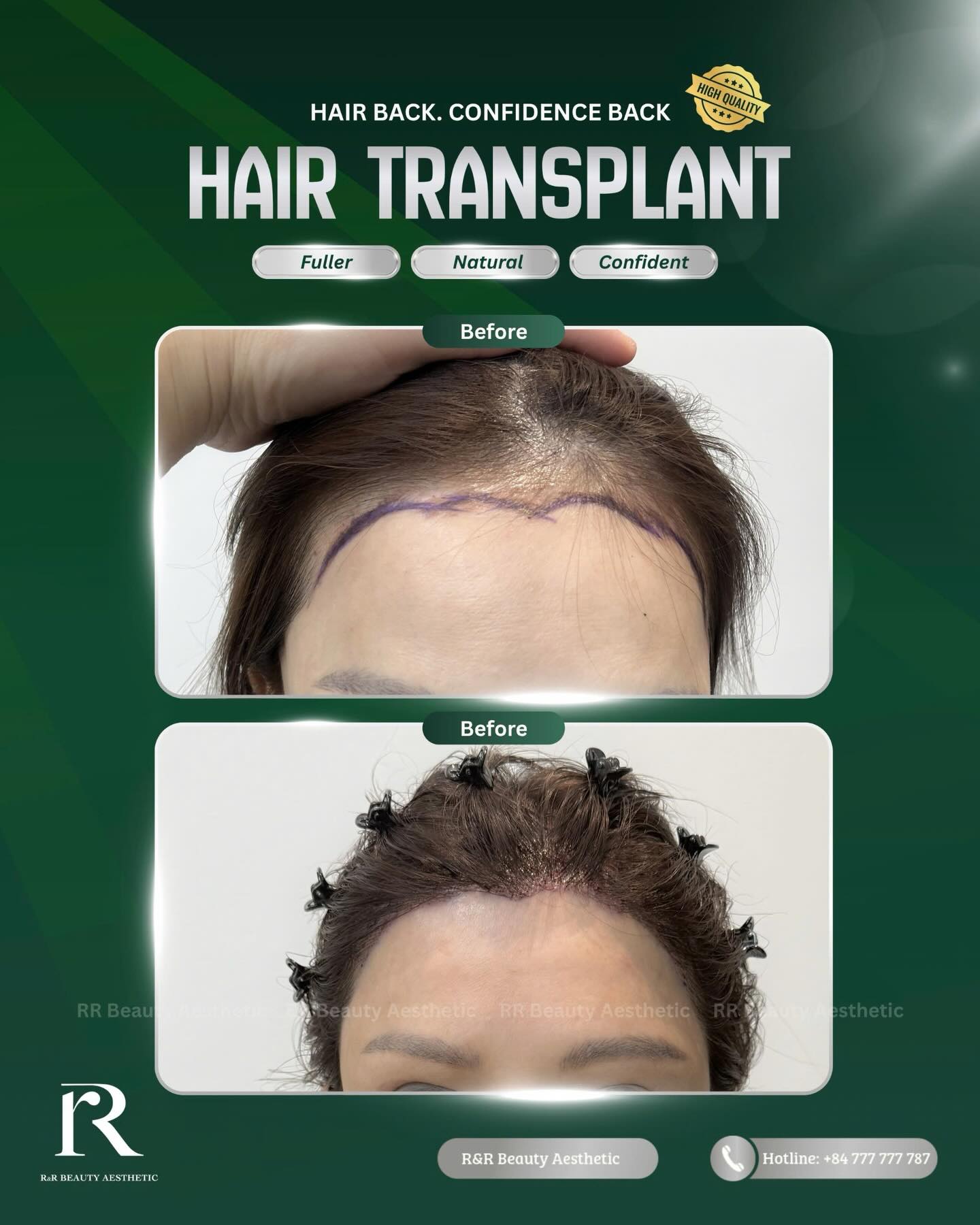 Hair back. Confidence back. ✨
Hair Transplant is designed to restore:
✨ Fuller hair density
✨ Natural-looking hairline
✨ More confidence in everyday life
Using your own healthy hair follicles,
each graft is carefully placed to create a seamless, natural result that blends with your facial proportions.
DM for your personalized consultation today 💬
Contact Information:
Vietnam Clinic
R&R Beauty Aesthetic / R&R Beauty Clinic
📍 10A Truc Duong, An Khanh Ward, Ho Chi Minh City, Vietnam
Singapore Studio
R&R Beauty Studio
📍 416 Ang Mo Kio Ave 10, #01-985, Singapore 560416
.
.
.
#hairtransplant #hairrestoration #naturalresults #hairline confidenceboost
hair transplant natural hair restoration fuller hair density restore hairline autologous hair transplant before after natural results aesthetic clinic confidence boost healthy hair appearance grooming transformation