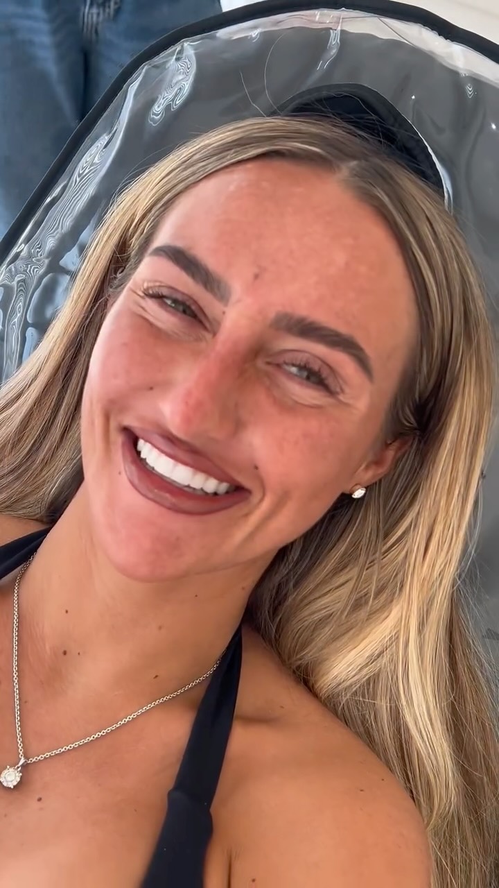 Our gorgeous @bridiedonkin come wanting 3 areas of antiwrinkle to relax the muscles in her forehead, frown & crows feet to help reduce fine lines and create a smooth, flawless appearance✨
Bridie also suffers with jaw clenching as a result of having strong masseter muscles so we added a little antiwrinkle to the Masseter muscle to relax this and as a result in 4-6 weeks Bridie should be pain free from clenching 💉
#masseter #sunderlandaesthetics #aestheticspractitioner #azzalure