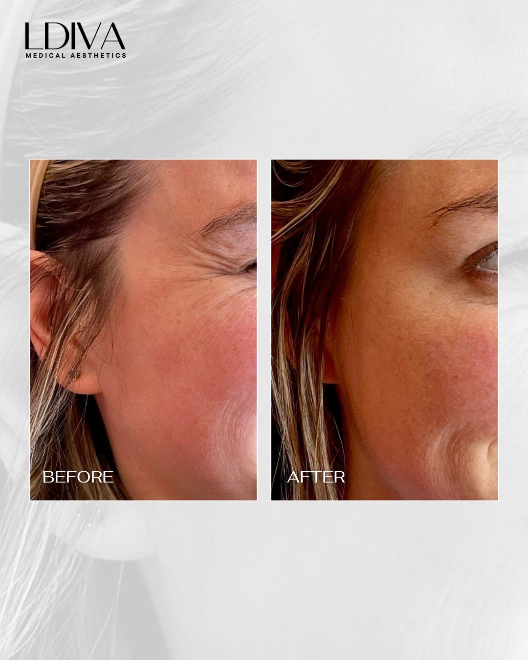 These lines aren’t from aging alone, they’re also from movement. Every time you smile or squint, the muscles around your eyes contract. Over time, those repeated expressions start to leave lines behind.
💉 Anti-wrinkle injections work by softening that muscle activity, which helps smooth existing lines and prevent them from getting deeper.
The goal isn’t to stop you from smiling. It’s to soften how those lines settle into the skin.
Schedule your transformations through our link in bio.
✨ Kingston & Ottawa, ON
#botoxottawa #botoxkingston #crowfeettreatment #ottawamedspa #kingstonmedspa