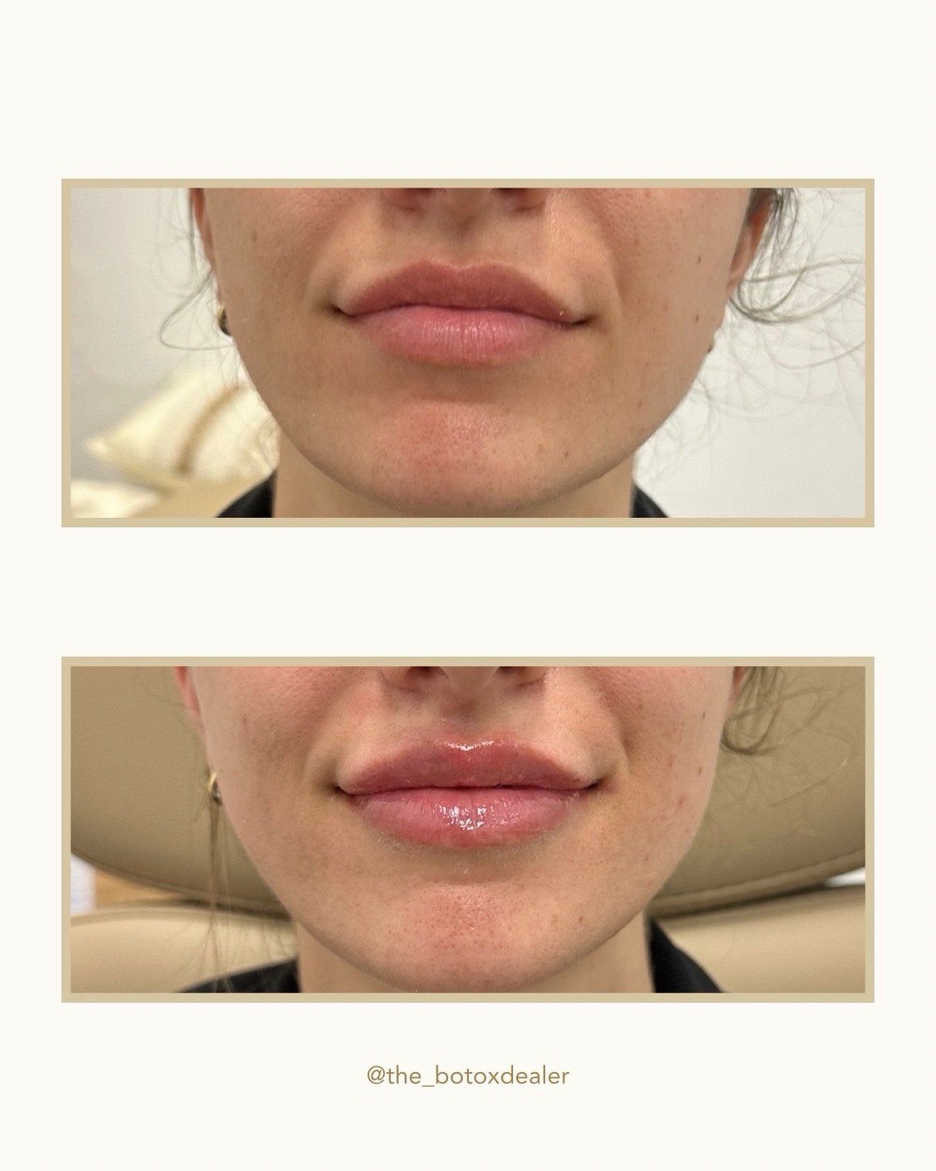 ⛽️ Gas is so expensive, and how far does it really get you? Filler lasts longer, and makes you feel better about yourself. Choose wisely😘
⠀⠀⠀⠀⠀⠀⠀⠀⠀
💉Procedure: Lip filler using Revanesse
⏱Time Spent: 30-45 minutes
❤️🩹Pain: Varies by client-topical anesthetic used
📅Longevity: Typically 6-12 months
🤩Results: Immediate—swelling and bruising is common for the first 5-7 days
🩹Aftercare: Avoid alcohol, NSAIDs, and exercise for 24-48 hours after procedure. Instructions provided at the time of your appointment