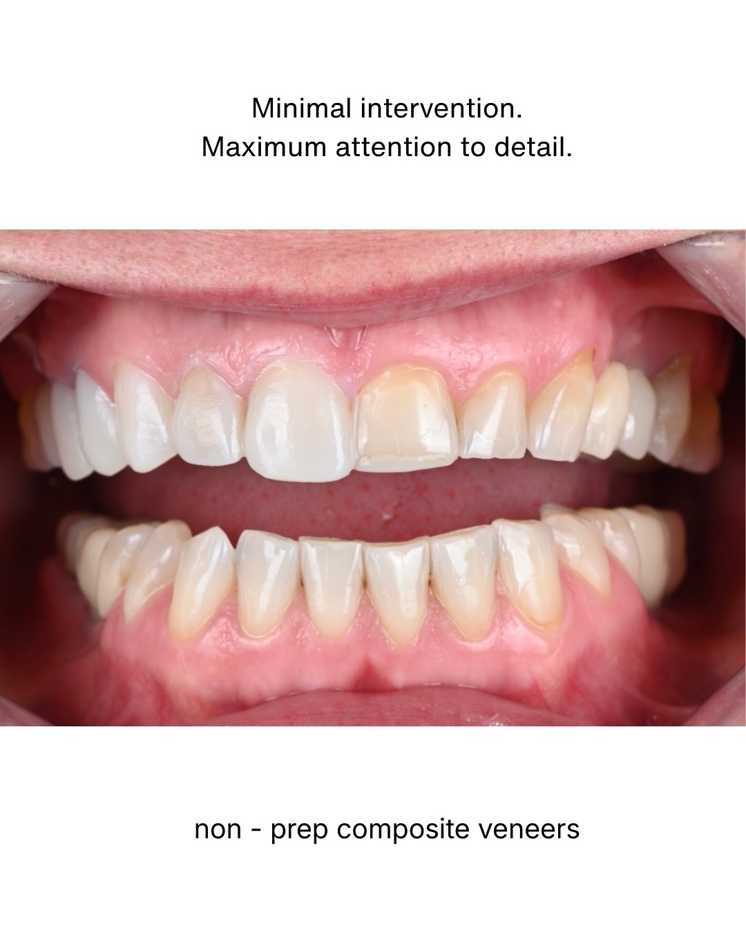 Composite bonding is often perceived as a simple cosmetic procedure.
In reality, achieving a natural and stable result requires careful planning, precision, and respect for facial harmony and function.
In this case, the objective was not to create an artificial “perfect smile,” but rather to restore balance while maintaining individuality and natural expression.
The mockup phase allowed evaluation before treatment, while adhesive isolation protocols helped ensure precision during execution.
Conservative dentistry can be highly aesthetic — when approached with detail and restraint.
#compositeveneers
#nonprepveneers
#compositebonding
