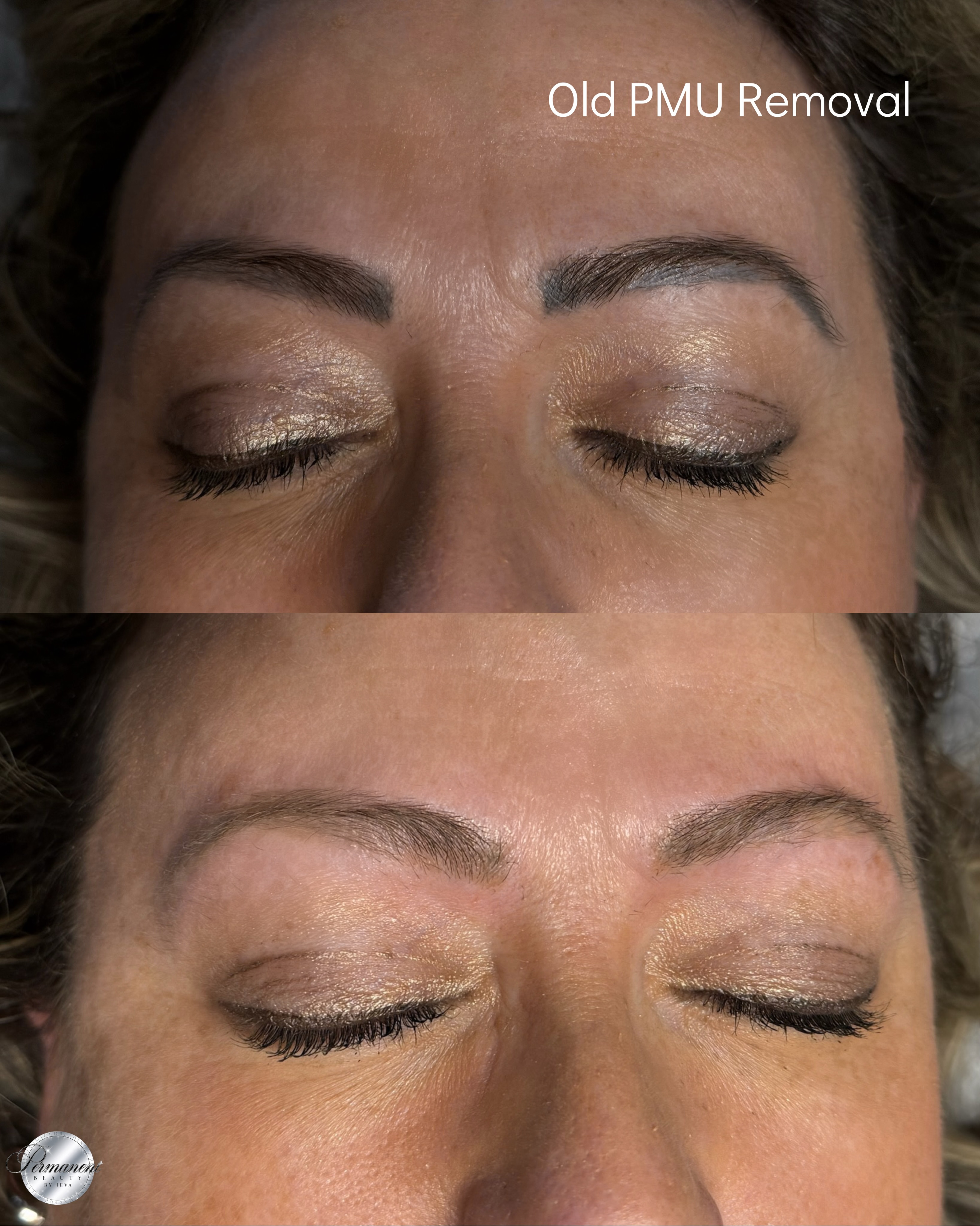 If your old brow tattoo turned gray, red, uneven or simply you don’t like it anymore — laser PMU removal can help safely fade unwanted pigment while keeping the skin and brow hairs protected. My laser works effectively with multiple colors.
I focus on gentle, gradual removal with healthy skin always as the priority 🤍
Swipe to see the process ➡️✨
📩 DM me if you have questions about this procedure.
Link for booking in BIO.
Permanent Makeup Services,
Tattoo Removal & Carbon Laser Facial
⬆️Book apt with the link in bio
✨Free Consultation available
📍Oshawa, Ontario
✉️browsbyieva@gmail.com
☎️416-804-6749
Website:
permanentbeautybyieva.com
#lasertattooremovaloshawa #laserremovaloshawa#evolaser#tattooremovaloshawa#pmuoshawa