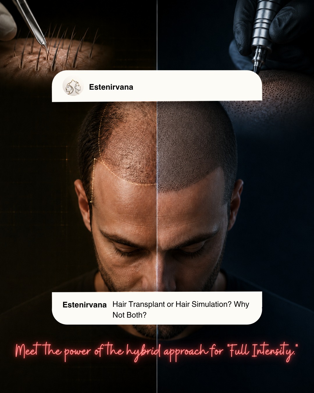 The “either this or that” era in hair restoration is over!
The Hybrid Approach we offer at Estenirvana provides a revolutionary solution for our patients with limited donor areas. While hair transplantation gives you natural hair strands, hair simulation professionally shades the visible scalp gaps in between. The result? Maximum density and a completely natural look! 💎
We combine both of our areas of expertise to bring your dream look to life. We’re here to create the most suitable plan for you.
#hairtransplant #hairsimulation #hybridapproach #hairrestoration #hairtransplantation #scalpsimulation