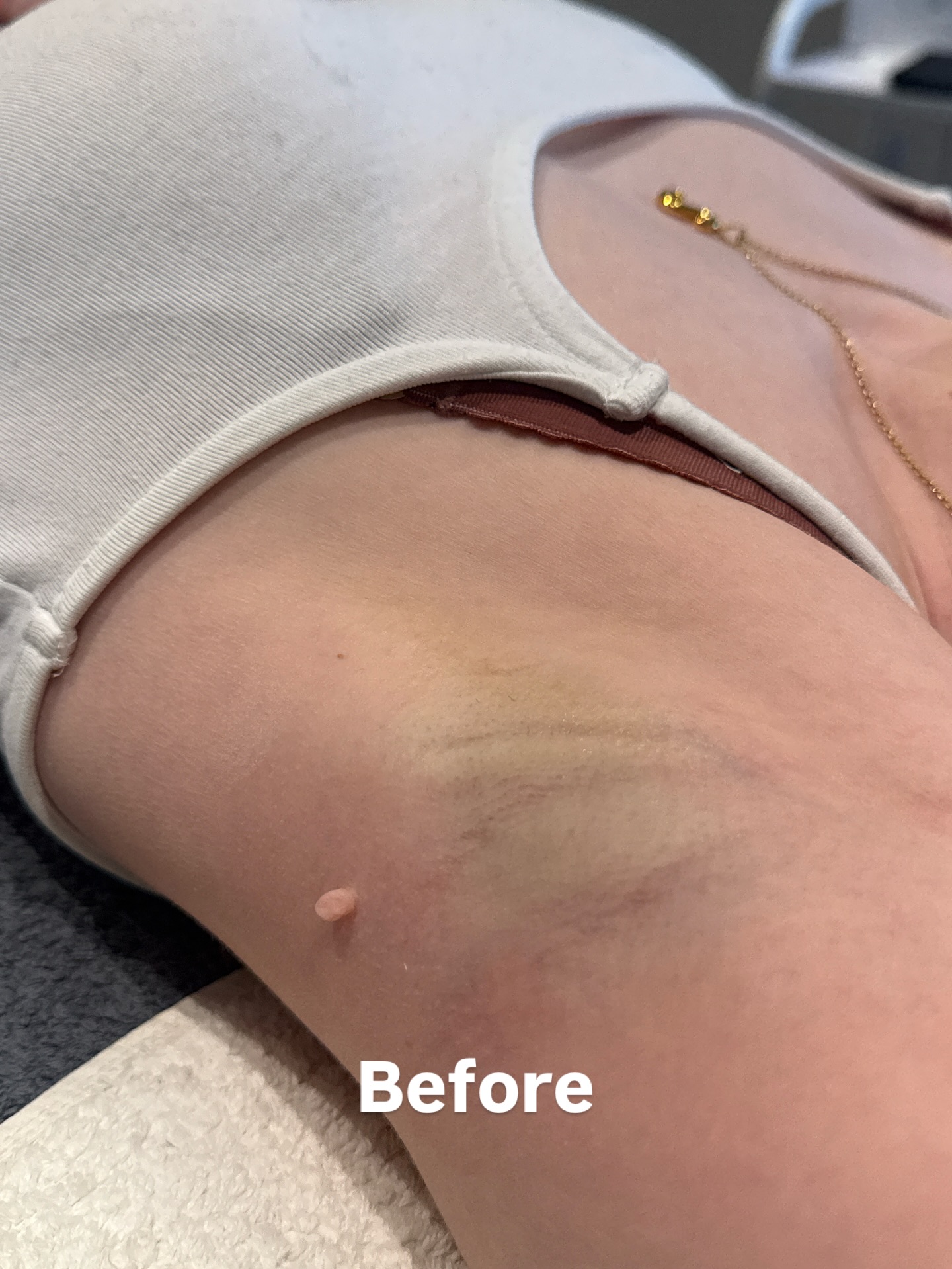 Summer’s coming :)
Skin tag removal results — before, after, and healed results one month later.
Real skin. Real transformation. Real confidence.
Call us on 01273 770880
or email info@thebeautyplacehope.com to book your consultation
Feel confident in your skin this summer.
#skintags #skintagremoval #brighton #brightonandhove #summer #confidence #beautyclinic #thebeautyplvehove