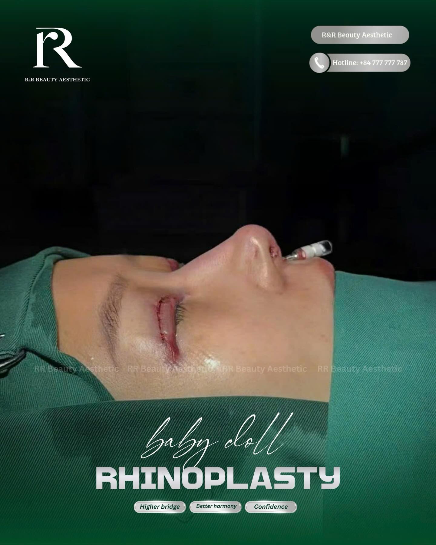 With Baby Doll rhinoplasty:
🔥 A more refined and balanced nose shape
🔥 Softer, more harmonious facial proportions
🔥 A smoother profile from every angle
🔥 Natural-looking results that don’t appear overdone
DM us to book your consultation
Limited appointments available each day
.
.
.
#rhinoplasty #nosecontouring #douyinstyle #facialharmony #naturalresults
douyin rhinoplasty
natural nose shape
nose contour result
before after rhinoplasty
harmonious face
confidence after rhinoplasty