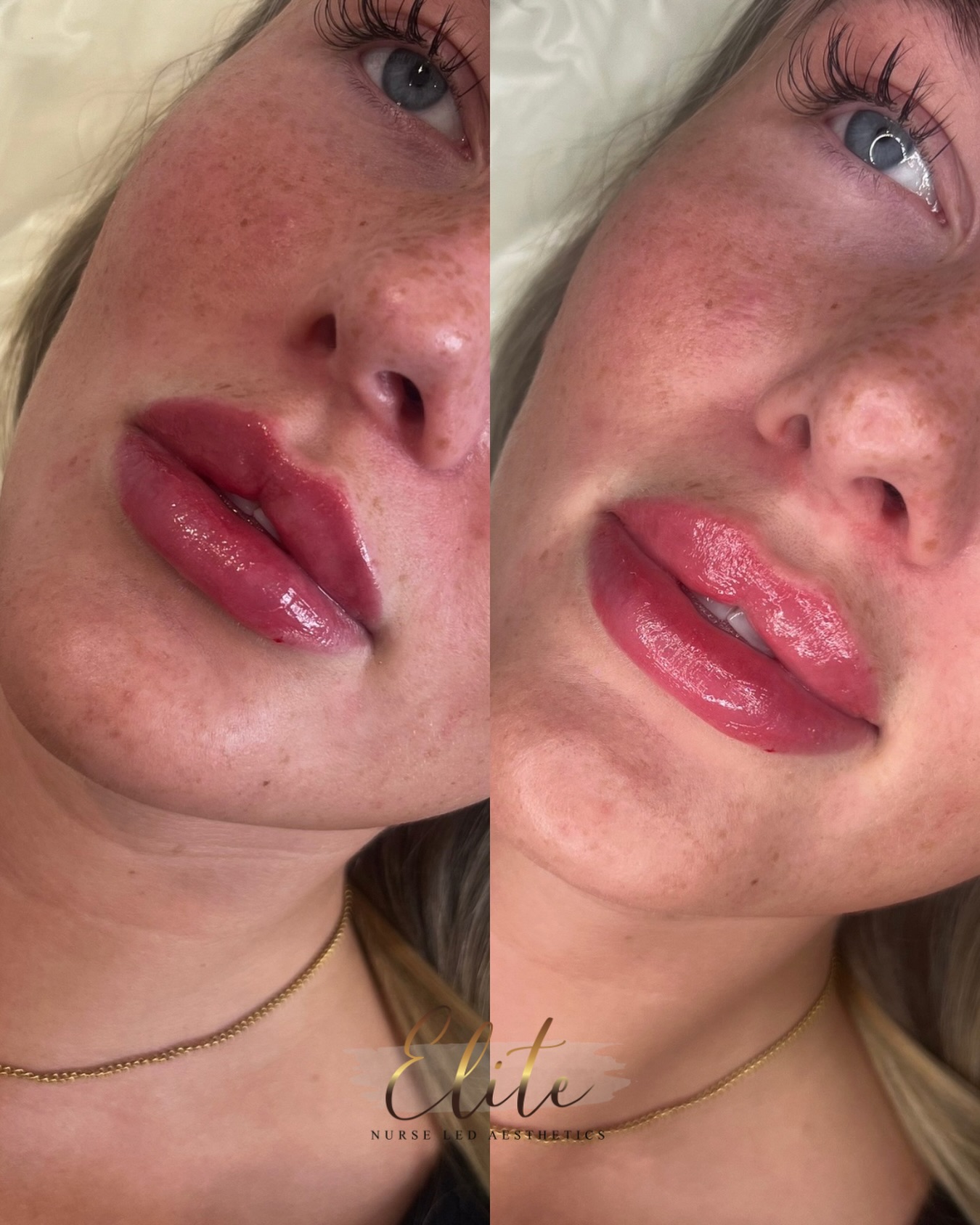 š Client Appreciation Post š
Weāre so grateful to have such stunning, loyal clients who trust us with their beauty journey!
Hereās a fresh look after a lip filler treatment for one of our regulars ā natural, plump, and perfectly balanced.
Thank you for choosing Elite Nurse Led Aesthetics again and again. Your confidence inspires us every day!
Ready for your own glow-up? Book your consultation today.
š© Call or WhatsApp 07596 389971
š Batley, West Yorkshire
#ClientAppreciation #LipFillerGlowUp #EliteNurseLedAesthetics #LoyalClients #NaturalLips BatleyAesthetics ThankYou