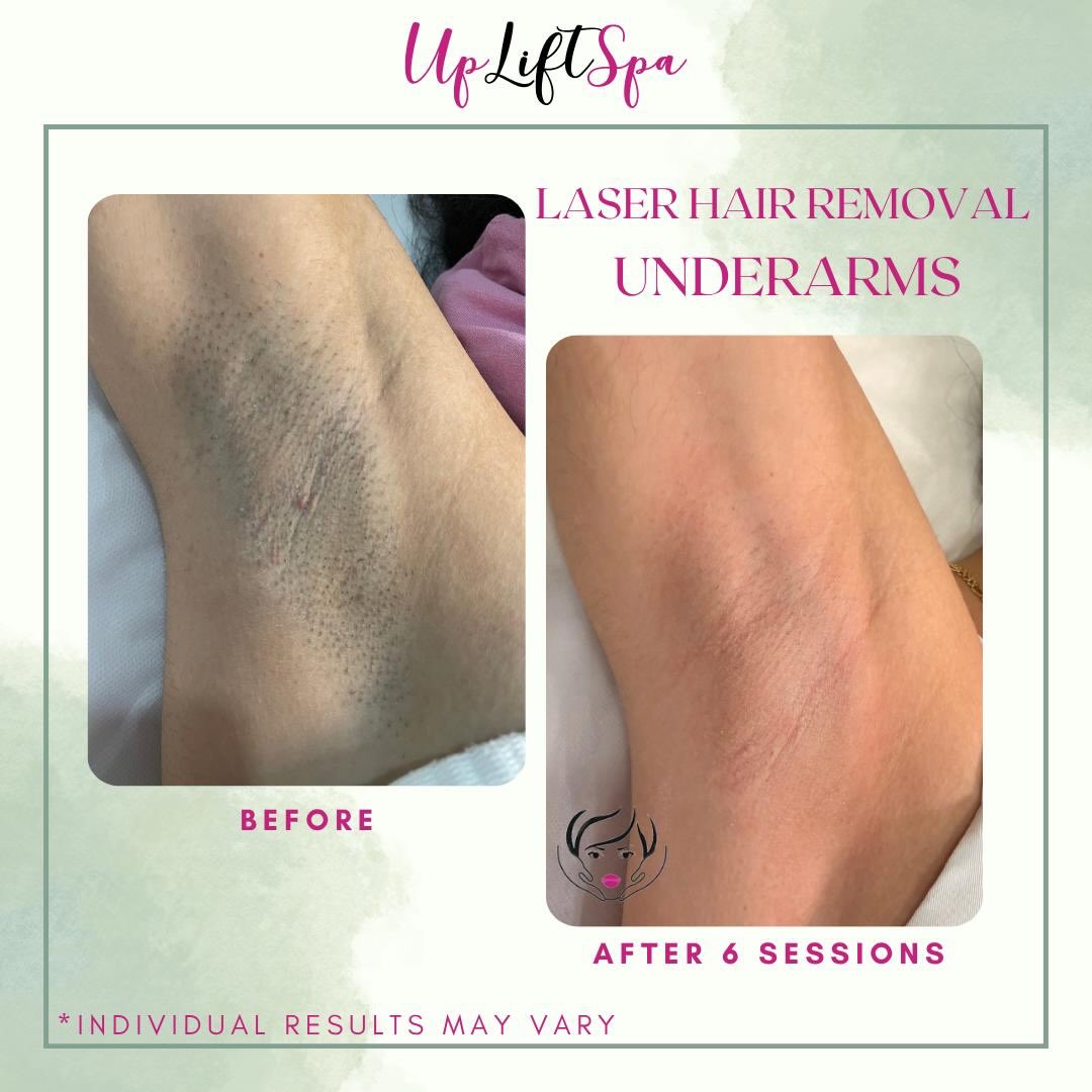 The razor struggle is real — and it’s not just about hair. 🙅🏽♀️
Shaving can leave behind darkening, bumps, and irritation that builds up over time. Our Candela GentleMax Pro laser addresses all of it — hair, hyperpigmentation, and ingrowns — so your skin can finally just breathe.
No filters. No touch-ups. Just real results that come from staying consistent.
💬 DM us “LASER” to learn about our bundle packages and lock in your sessions. Your skin deserves that investment.
#UnderarmLaser #laserhairremoval #MedSpaEastHarlem #candlelagentlemax