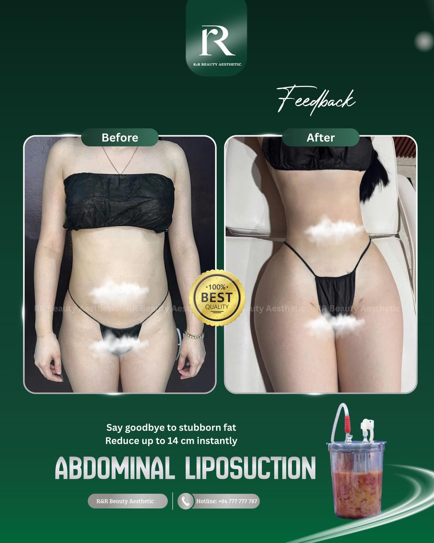 ✨ Redefine your silhouette with a more sculpted, confident version
Signature body contouring combo combines :
✨ Abdominal Liposuction & ✨ Peach-Shaped Butt Enhancement
✔ Reduce stubborn belly fat
✔ Create a more defined waistline
✔ Enhance fuller peach-shaped curves
✔ Improve body proportions naturally
✔ Performed by experienced aesthetic specialists
.
.
.
Contact Information:
Vietnam Clinic
R&R Beauty Aesthetic / R&R Beauty Clinic
📍 10A Truc Duong, An Khanh Ward, Ho Chi Minh City, Vietnam
Singapore Studio
R&R Beauty Studio
📍 416 Ang Mo Kio Ave 10, #01-985, Singapore 560416
.
.
.
#bodycontouring #liposuction #buttaugmentation #peachshape aestheticclinic rrbeautyaesthetics luxurybeauty koreanaesthetic bodygoals medicalbeauty