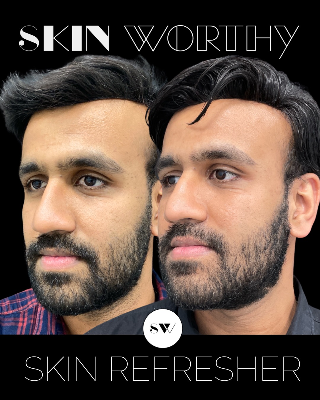 Before ➡️ After: refreshed, smoother, and healthier-looking skin.
Our Skin Refresher is a stacked Dermal Infusion + Microneedling treatment designed to deeply cleanse, extract, exfoliate, and infuse the skin with hydration and nutrients.
From there, microneedling helps target pigment, texture, and overall skin quality, paired with a customized serum selected specifically for his skin type.
Low to no downtime, and a perfect spring/summer maintenance treatment to renew, refresh, and keep skin looking its best. ✨
Available as a package of 3 or find it in our brand new Beauty Club Memberships.