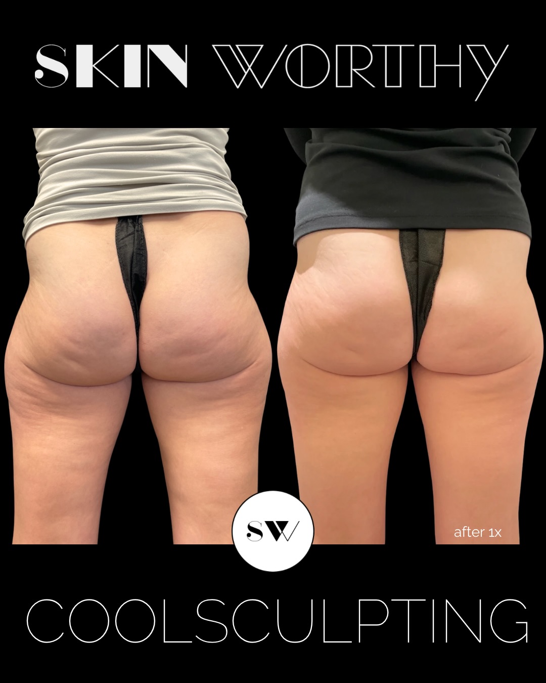 One treatment. One month. Real outer-thigh contouring results. ✨
CoolSculpting is an effective, non-surgical, low-risk treatment with no downtime, especially when your provider understands the technology, applicator placement, and how to create the best possible outcome for your body.
Now until June, save 25% on all CoolSculpting treatments and receive an additional $350 cash-back offer from CoolSculpting.
Message us for details or to book your consultation with Anne to get a comprehensive assessment. 💙