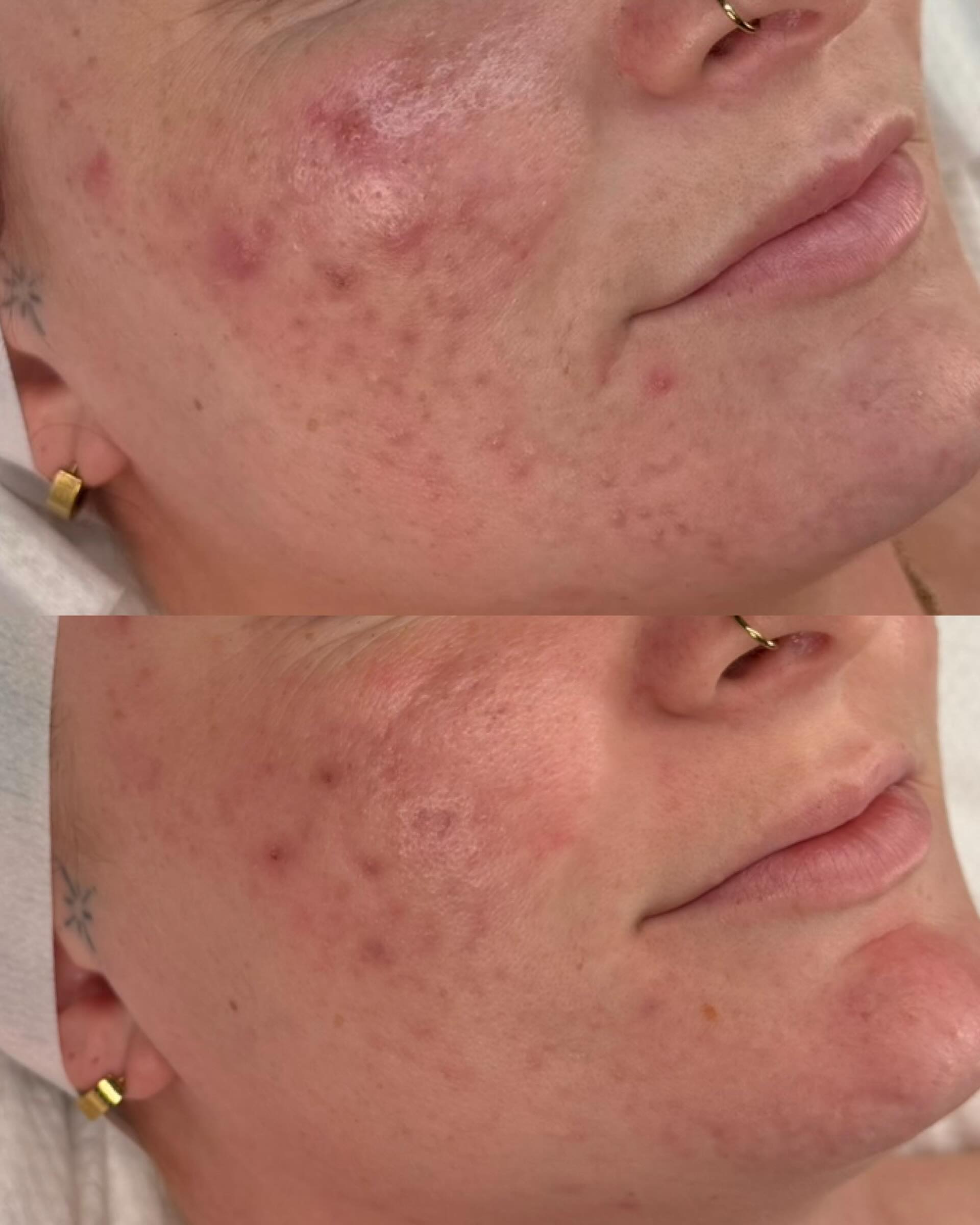 This is what happens when you stop treating acne like a surface problem 👏🏼✨
Because no - acne is NOT just about skincare.
Anna’s skin journey has taken time, consistency, trust, and a LOT of work from both of us, but look at the difference 😍
The active breakouts have calmed down, inflammation is massively reduced, and now we move onto clearing the PIE, rebuilding skin health, and refining the scarring ⚡️
But this didn’t happen from random facials and hoping for the best.
We looked at EVERYTHING:
• hormones
• stress
• sleep
• gut health
• diet
• inflammation
• skincare routine
• lifestyle habits
Because acne is an inflammatory condition, and if you only treat the surface without addressing what’s happening internally, you WILL keep going round in circles ⭕️
And this is exactly why consistency matters so much.
There were times Anna’s skin purged.
Times she felt frustrated.
Times it would’ve been easy to give up.
But she trusted the process, stayed consistent, followed the plan, and now her skin is responding BEAUTIFULLY 👏🏼
This is what happens when you work WITH your skin instead of against it 🫶🏼
If you’re exhausted trying products, treatments, antibiotics, or TikTok trends that never actually fix the problem - this is your sign to stop guessing 🪧
DM me “ACNE” and I’ll send you my FREE e-book:
“Why Your Acne Isn’t Clearing (And What You’re Missing)” to start you on your journey to clear skin ✨