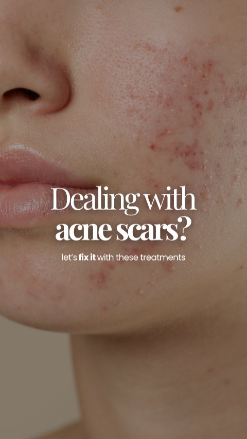 Dealing with acne scars? ✨
Let’s work on smoother, clearer, more confident skin with a personalised combination of treatments designed for different types of acne scars and skin concerns 💫
Featured treatments in this video:
▫️ Pico Laser
▫️ Fractional Laser
▫️ Long Pulsed Laser
▫️ Sylfirm X
▫️ Rejuran
From post-acne marks and enlarged pores to uneven texture and redness, the right treatment plan can make a visible difference over time 🌿
Every skin journey is different — that’s why we focus on customised solutions to help you achieve healthier-looking skin with minimal downtime.
DM us to start your skin transformation journey ✨