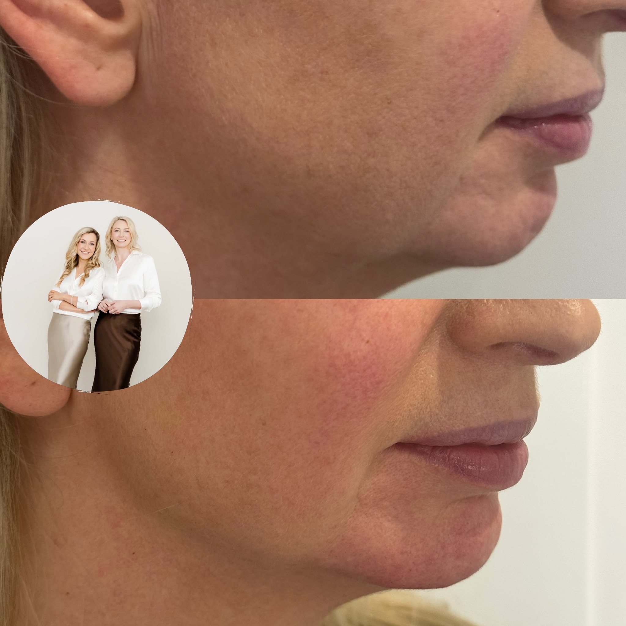 Sharp angles, sculpted lines, and a profile that just hits different ✨
Jaw and chin filler is one of my favourite ways to enhance natural structure—whether it’s creating a more defined contour, balancing proportions, or subtly correcting the side profile.
The best part? It’s all about refinement, not replacement. Small, strategic tweaks can make a big difference, giving that clean, confident look without losing what makes your face yours. 💉💫
Strong jaw, soft confidence, effortless glow.
#profilecorrection #elevate #chinfiller #jawline #chisel