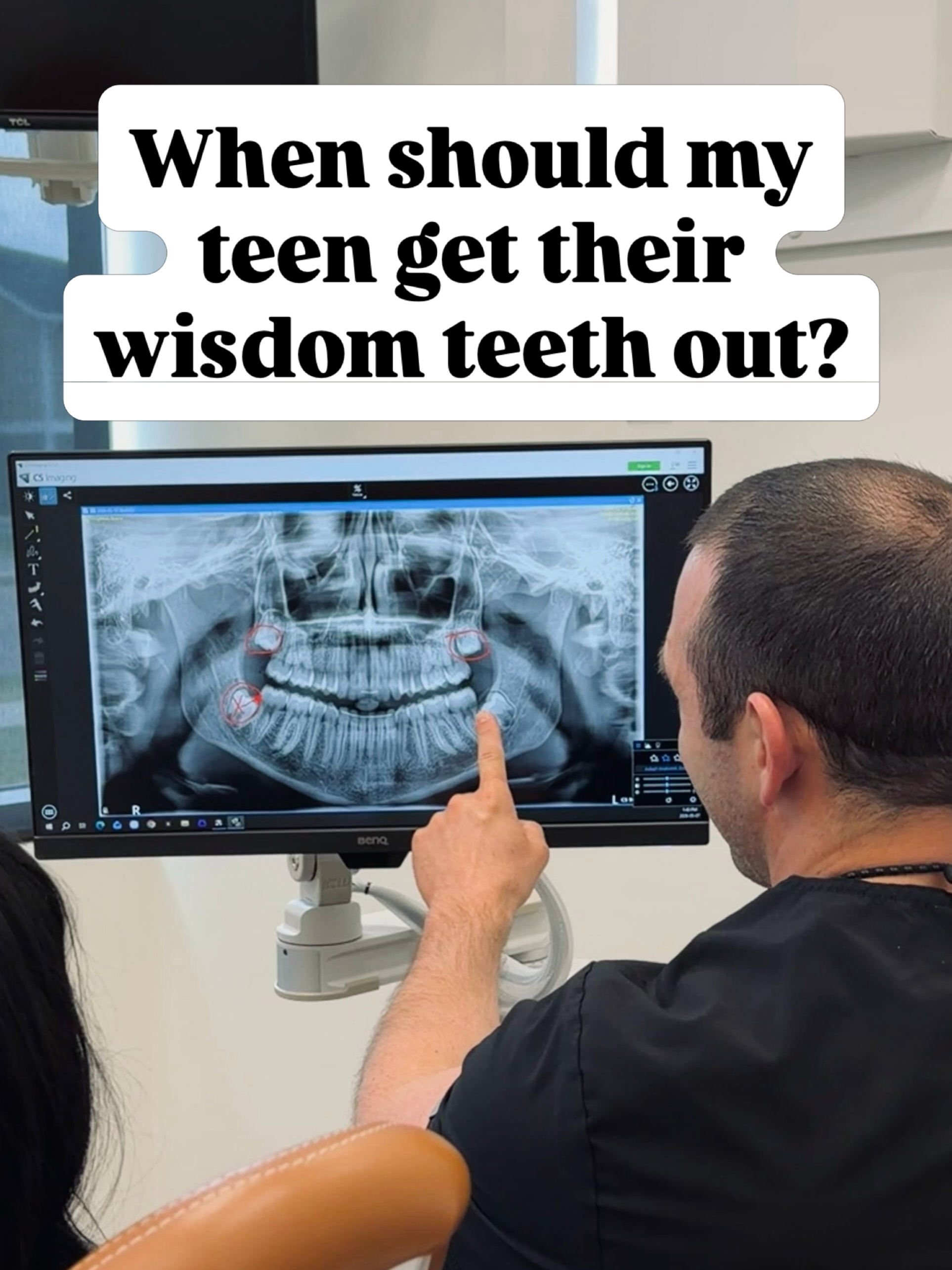 Not sure when your teen should have their wisdom teeth checked?
You’re not alone! This is one of the most common questions we get from parents.
And the answer? The best time is usually mid-late teen years, before those teeth cause problems!
We know wisdom teeth removals can be stressful. So we work with you to make it a good experience.
• Clear guidance before and after your procedure
• Comfort-focused care (including sedation options), and
• A plan that works around school and activities
Our goal is to make this as easy and stress-free as possible.
And yes—we help plan it around school, sports, and life! For lots of people, that means summer break is a great option!
Send us a message, call or text, or visit our website to book a consult
📞403-905-0522#
.
.
.
#redrockdental #medicinehatdentist #medicinehatwisdomteeth #brooksdentist wisdomteeth
