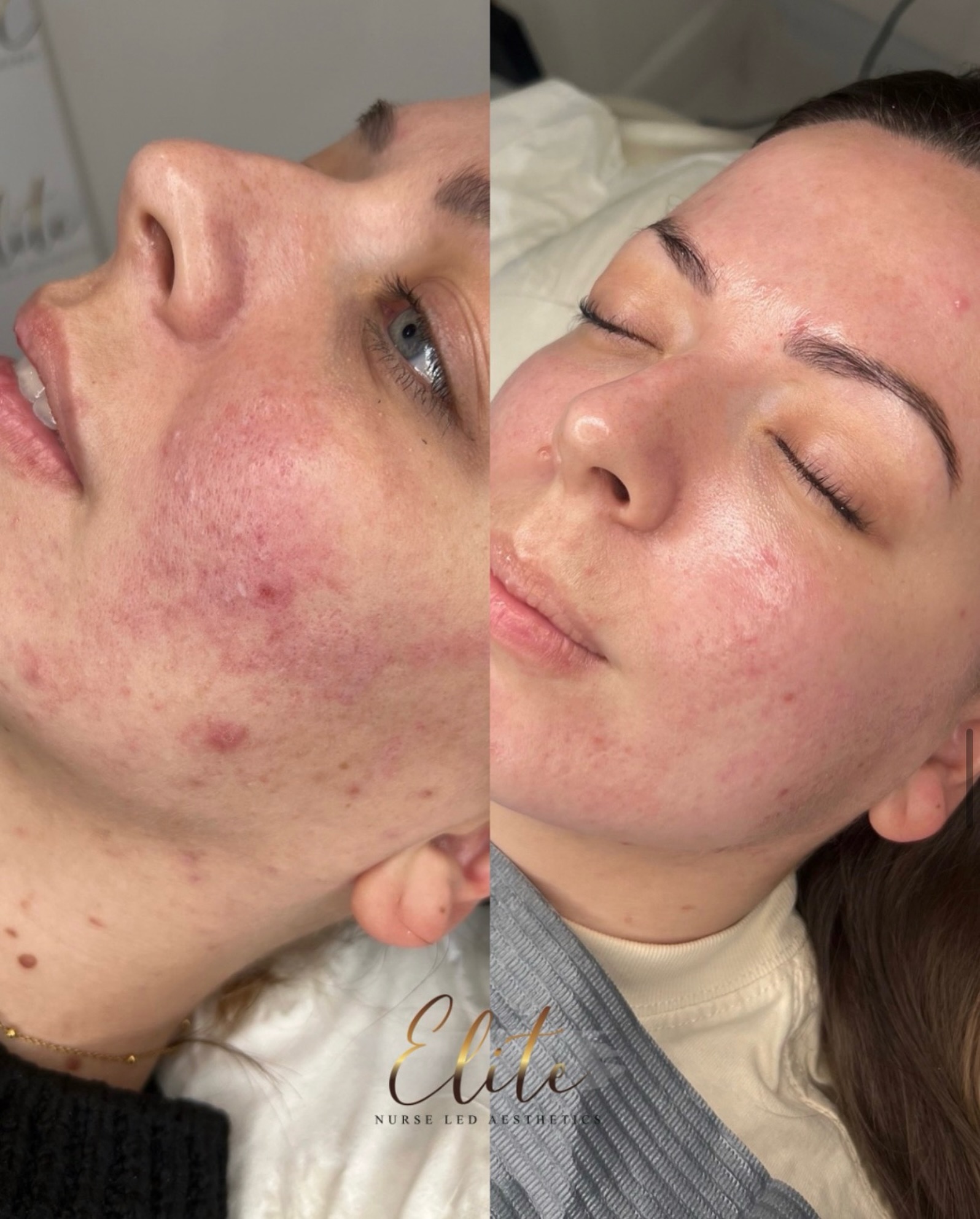 ✅ Proven Results
✨ Obagi Blue Radiance Peel: Incredible Acne & Redness Transformation! ✨
Look at these amazing results after a course of Obagi Blue Radiance Peel treatments! Our client struggled with acne and redness, but with professional care and a tailored treatment plan, their skin is now clearer, smoother, and glowing!
✔️ Reduces active acne & breakouts
✔️ Calms redness & inflammation
✔️ Improves skin tone & texture
✔️ Boosts radiance with minimal downtime
If you’re struggling with acne or redness, this medical-grade peel could be the game-changer your skin needs! DM us or visit our bio link to book your consultation today.
#aesthetics #aestheticsyorkshire #aestheticswakefield #aestheticswakefieldyorkshire #skincareyorkshire skincarewakefield aestheticniurse aestheticnurseyorkshire lipfiller yorkshirelipfiller wakefieldlipfiller wakefieldlipfillers yorkshirefiller microneedling microneedlingyorkshire wakefieldmicroneedling yorkshirefacials exosomeskincare hairtreatment exosomeshairtherapy exosomeshair
ObagiBlueRadiance AcneTreatment ClearSkin SkinTransformation GlowUp