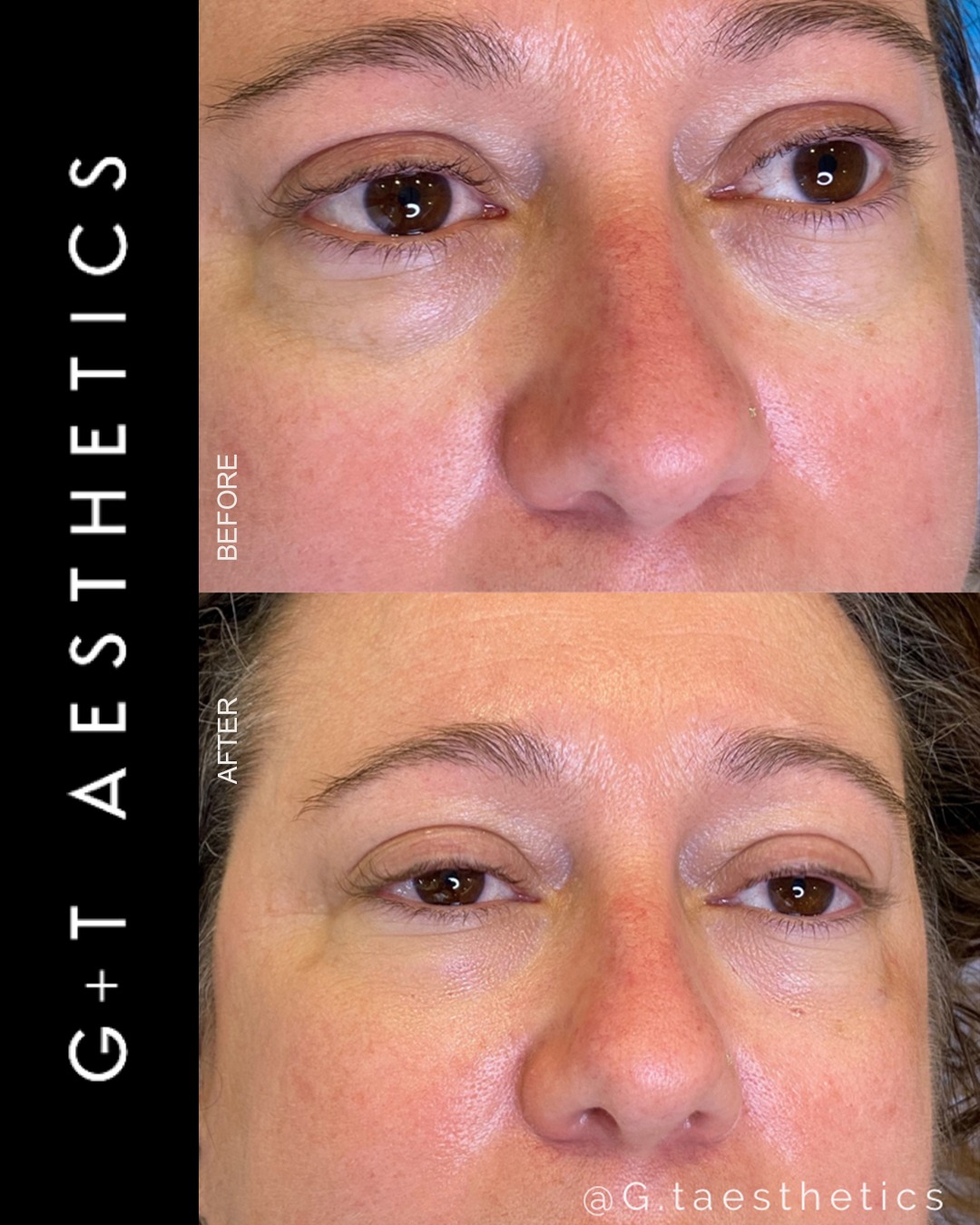A refined approach to under-eye rejuvenation.
Tear trough filler can reduce the appearance of hollowness and dark shadows, creating a more rested and refreshed look.
📲Enquire or visit www.gtaesthetics.co.uk for more info.
#TearTroughFiller #UnderEyeTreatment #BeforeAndAfter #FacialRejuvenation #AestheticClinic #GTAesthetics