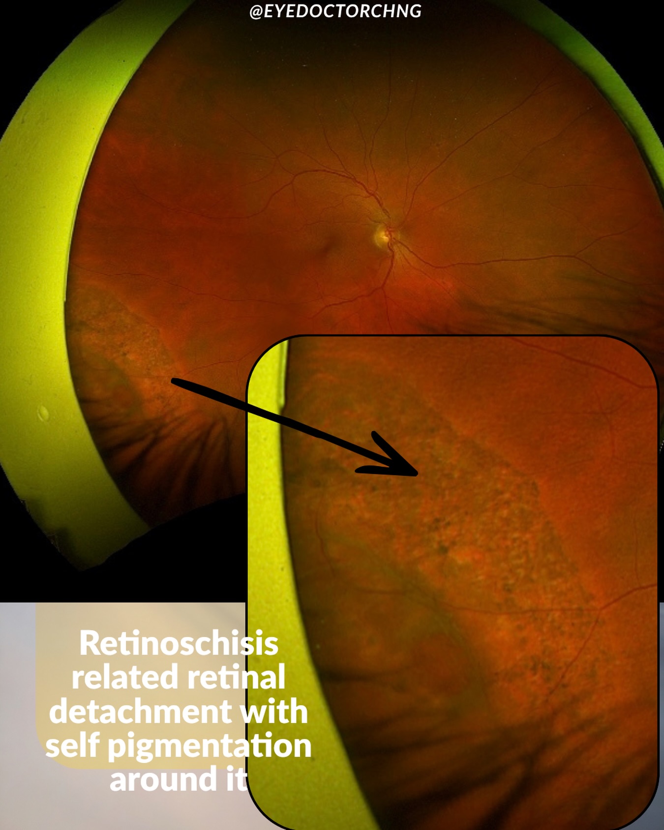 Retinoschisis is a splitting of the of the neurosensory layer of the retina into two layers. It is commonly a degenerative condition and found in hypermetropic (long sighted) people. Normally asymptomatic and sometimes in around 5-7% people there can be a schisis-detachment which is a localised retinal detachment associated with outer layer or leaf breaks as seen in the image above. Less than 3% becomes a symptomatic progressive retinal detachment requiring surgery.
#retinoschisis #retinaldetachment #ophthalmology #vitreoretinal #eyedoctorchng