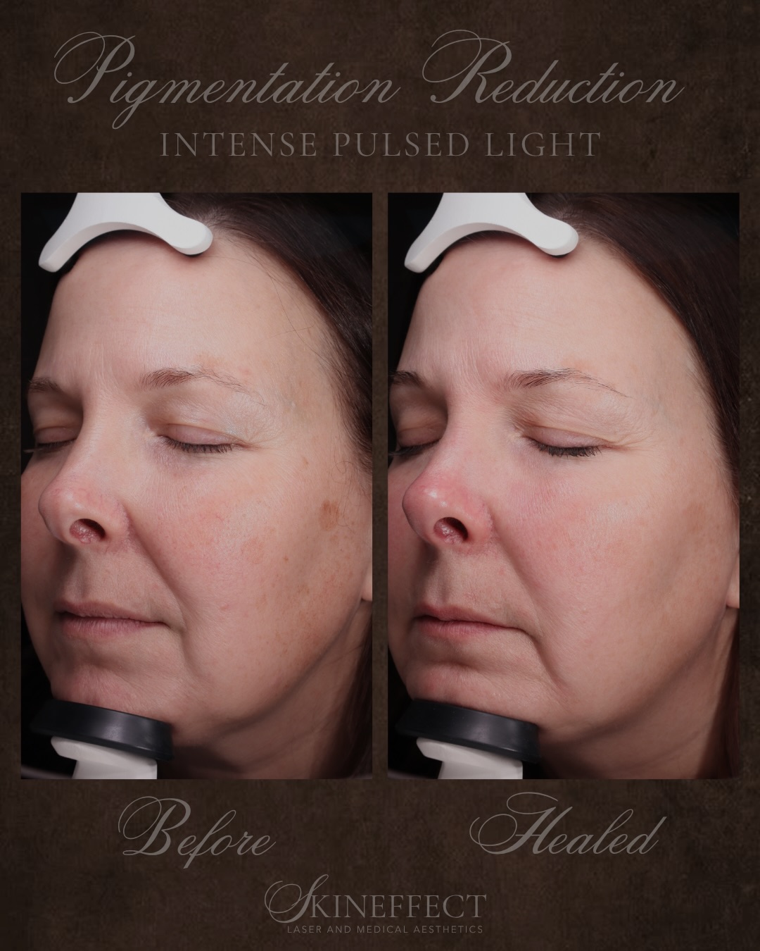 Love your Skin Member Results: pigmentation reduction through IPL ⚡️
IPL works beneath the surface; breaking down pigmentation so your complexion can resurface, clearer and more even than before.
Results like these take time. This client completed a series of IPL’s to reach this level of pigmentation reduction.
Send this to someone who would enjoy this transformation 💌
#ipl #medicalaesthetics #medicalaesthetician #medicalspa #yegmedispa