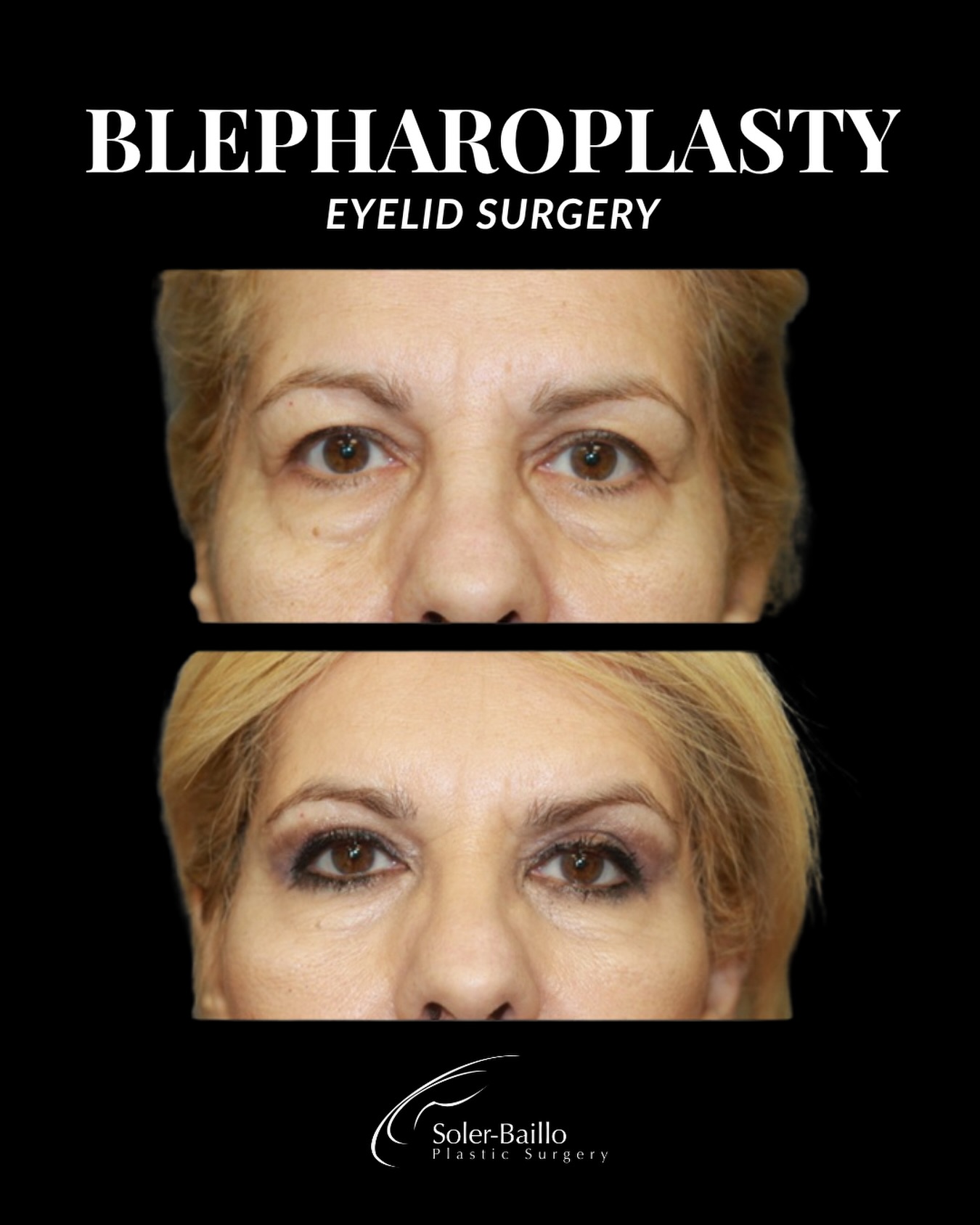 👁️ A refreshed look starts with the eyes.
Blepharoplasty can smooth puffiness, reduce excess skin, and create a brighter, more rested appearance while keeping your natural beauty front and center. Subtle changes, beautiful impact. ✨
Ready to learn if blepharoplasty is right for you? Schedule your consultation today.
#Blepharoplasty #EyelidSurgery #FacialRejuvenation #PlasticSurgery #NaturalResults