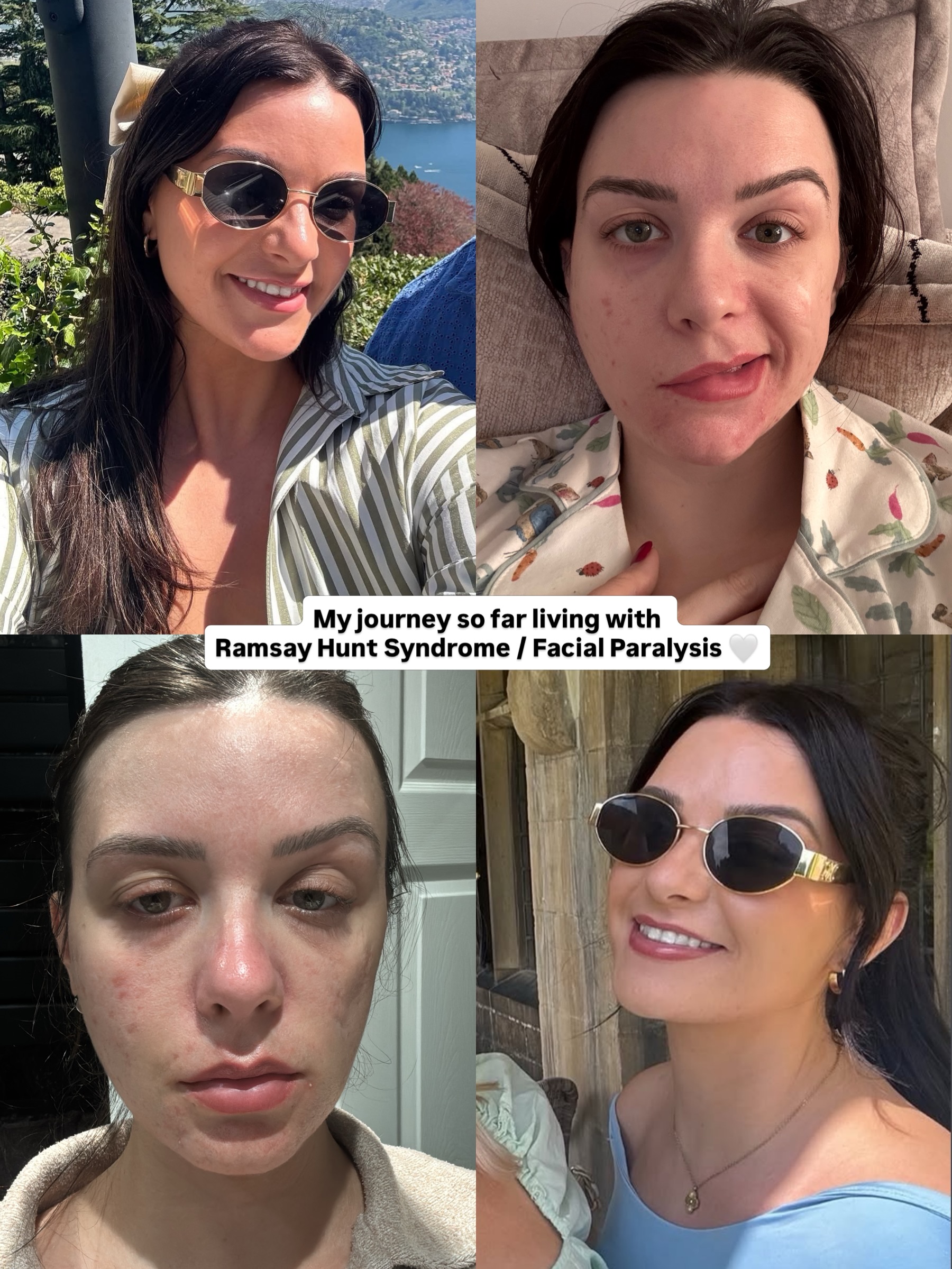 My journey with Ramsay Hunt Syndrome 🤍 *P.S ignore the spelling and word mistakes, me and auto correct aren’t friends and I should proof read 😂
Just to say, I’m not sharing this for sympathy at all, I feel sooooo strong and I’m 11 weeks into the journey now! But I want to spread awareness on this rare condition, especially for anyone who frantically searches every possible engine you can to find some answers like I did! You may have heard of RHS in passing as it was the reason Justin Bieber cancelled his world tour in 2022 when he was diagnosed with it!
Ramsay Hunt Syndrome happens when the same virus that causes chickenpox reactivates later in life. After chickenpox, the virus stays dormant in the nervous system and can “wake up” years later, often during periods of high stress, immune suppression, burnout, illness, or nervous system overload and frustratingly I had 4 months of being unwell with my pregnancy + a period of stress during this time.
When it reactivated, it attacked the facial nerve near my ear, causing inflammation and irritation to the nerve itself. Think of the nerve like an electrical wire, when it becomes swollen or damaged, the signals between the brain and facial muscles can’t travel properly. This is why facial weakness or paralysis can happen. That along with the pain of shingles is just next level 😅
So just a reminder that chronic stress doesn’t just affect mood or energy… it impacts the immune system and nervous system too, so please prioritise your wellbeing, even if this means disappointing others 🤍 #ramsayhunt #ramsayhuntsyndrome #facialparalysis #shingles