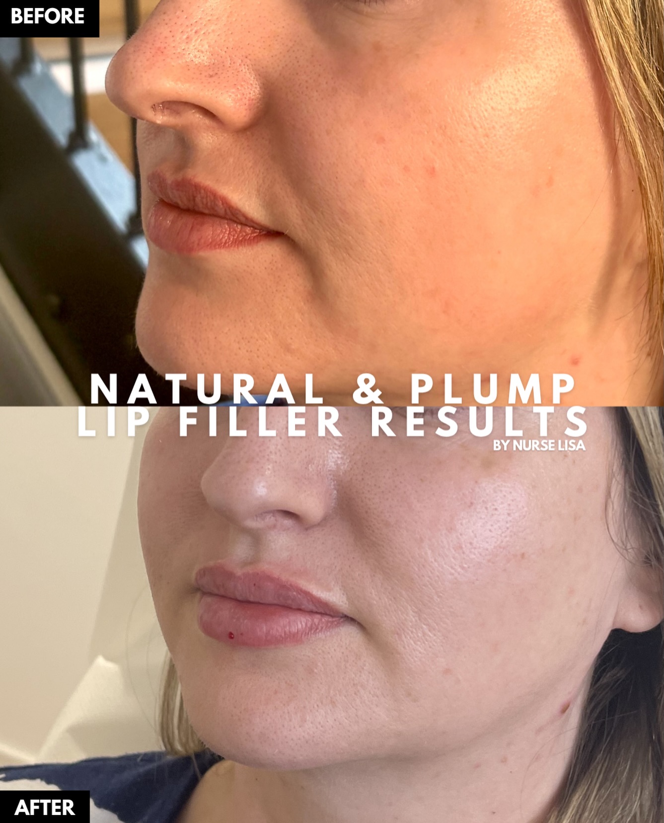 Lip filler results by Nurse Lisa! 💉
A lot of patients worry about looking “overdone”, but good lip filler should simply enhance what’s already there and suit the face beautifully.
At Niu Clinic, every practitioner is highly trained and experienced in delivering natural-looking results.
Book today via the link in bio.
#lipfiller #fillerresults #aestheticspractitioner #fillerbeforeandafter